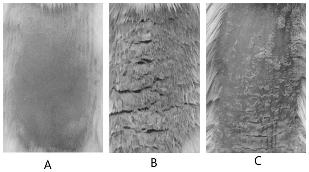 Application of gemcitabine in preparation of medicine for treating psoriasis, medicine and preparation method thereof