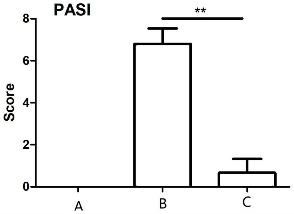 Application of gemcitabine in preparation of medicine for treating psoriasis, medicine and preparation method thereof