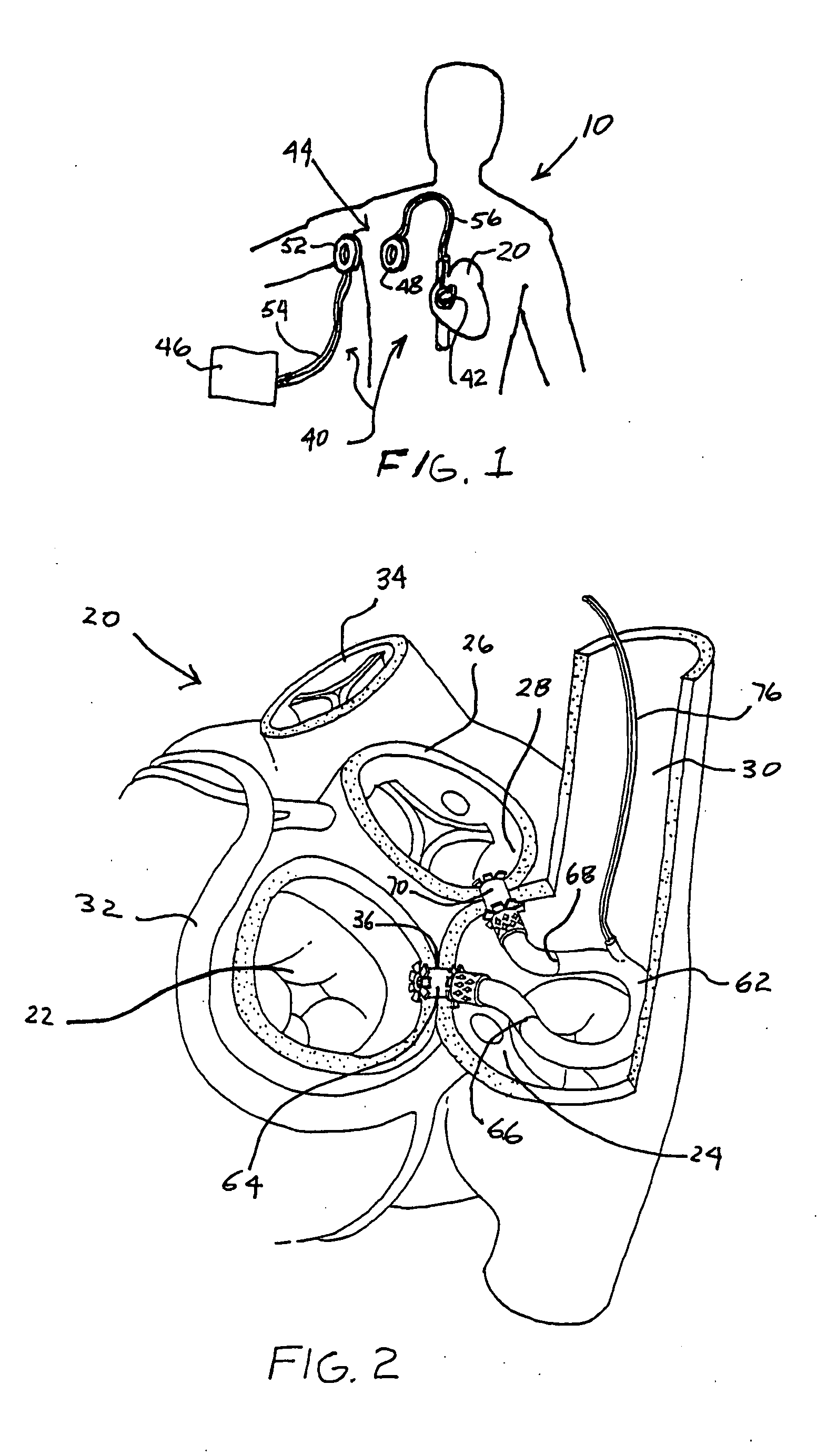 Left ventricular function assist system and method