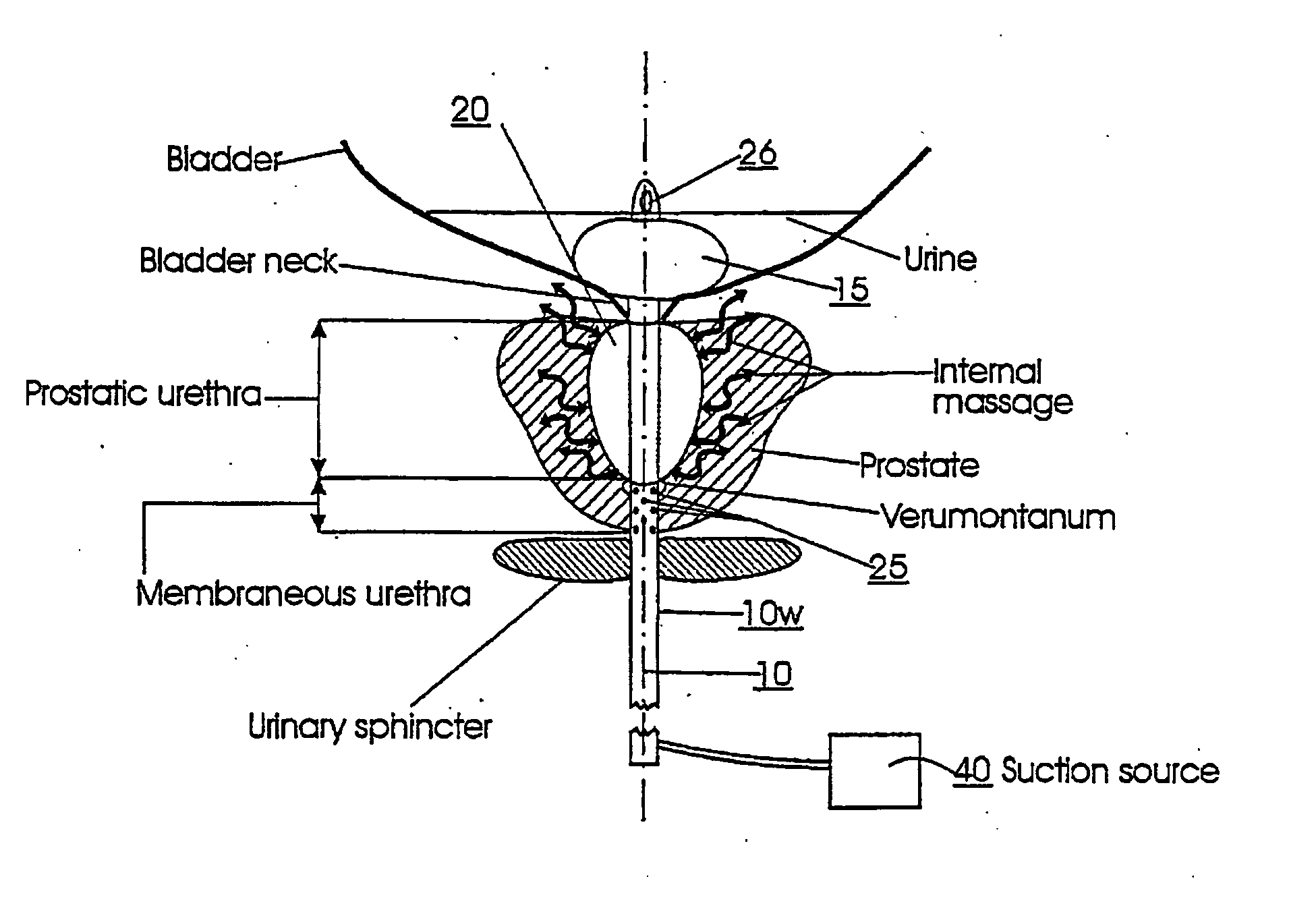 Catheters with suction capability and related methods and systems for obtaining biosamples in vivo