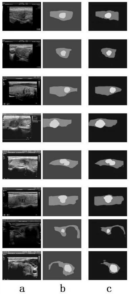 Segmentation method of thyroid nodule ultrasonic image based on semantic segmentation network PSPNet