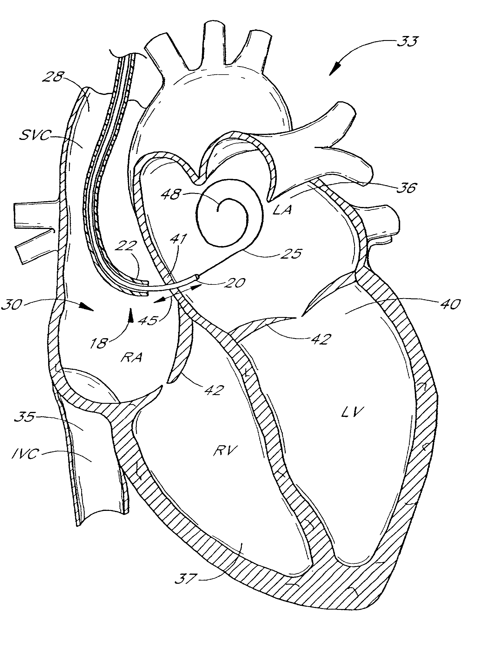 Systems and methods for detecting, diagnosing and treating congestive heart failure