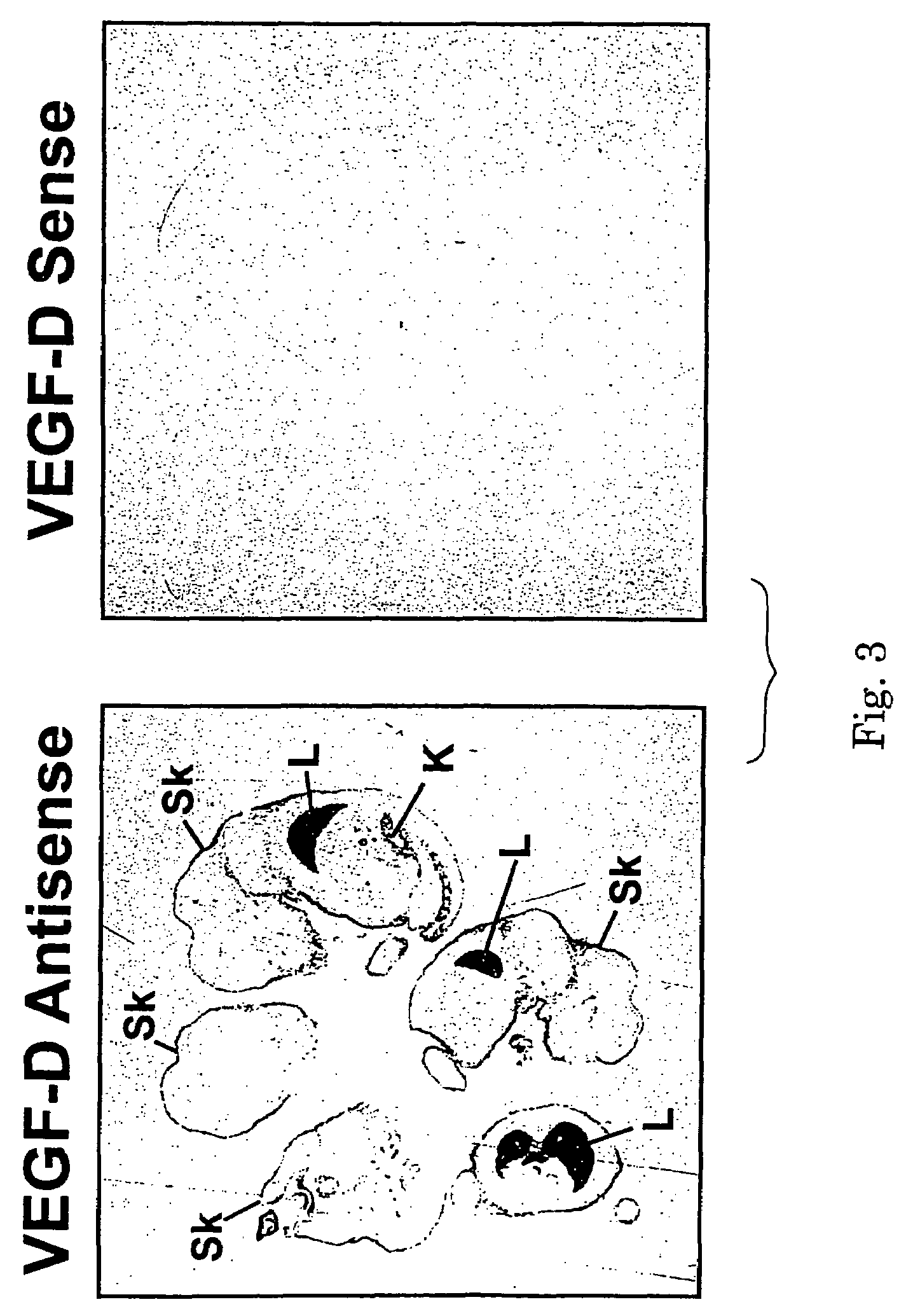 Methods for treating neoplastic disease characterized by vascular endothelial growth factor D expression, for screening for neoplastic disease or metastatic risk, and for maintaining vascularization of tissue