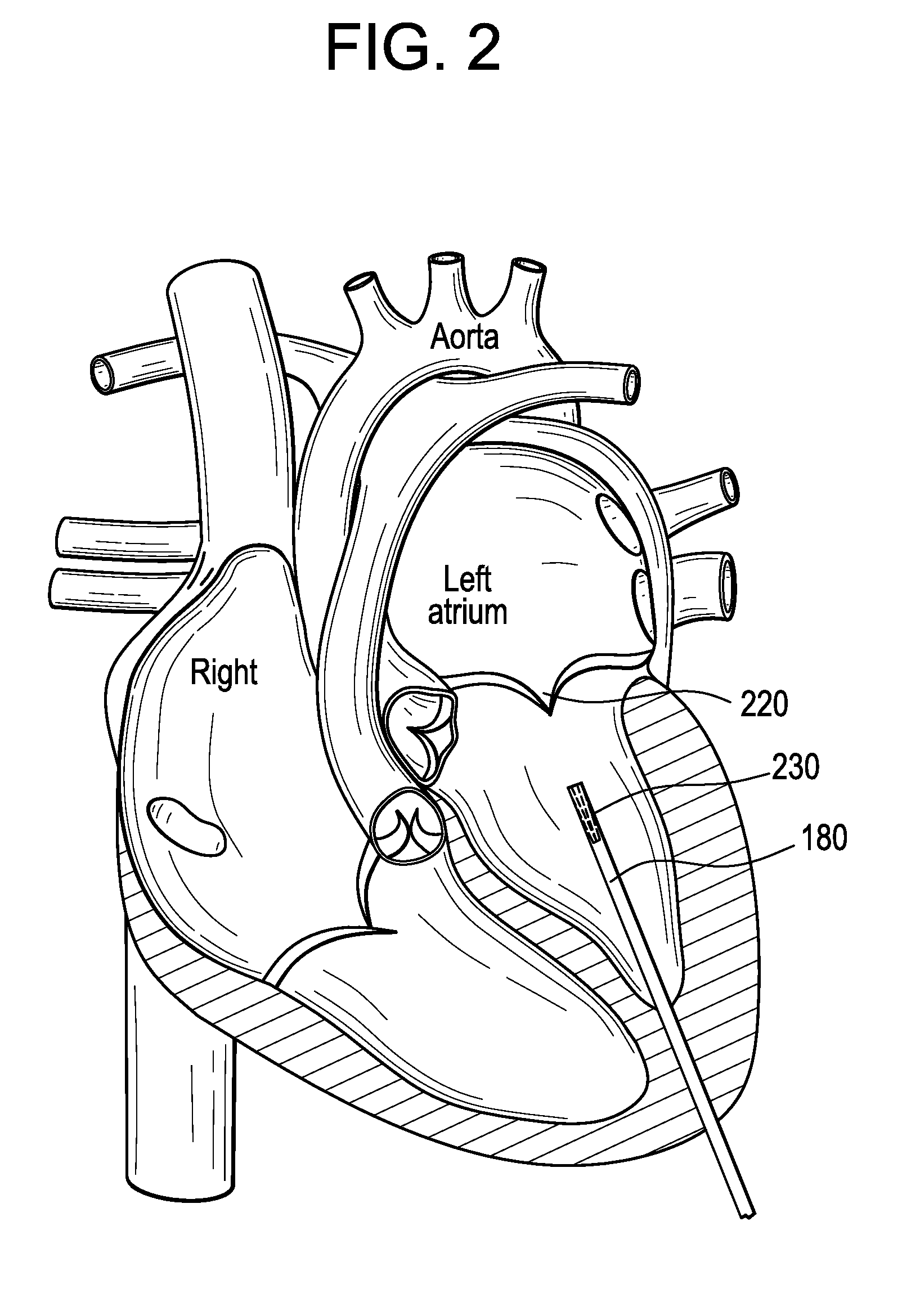 Multi-component designs for heart valve retrieval device, sealing structures and stent assembly