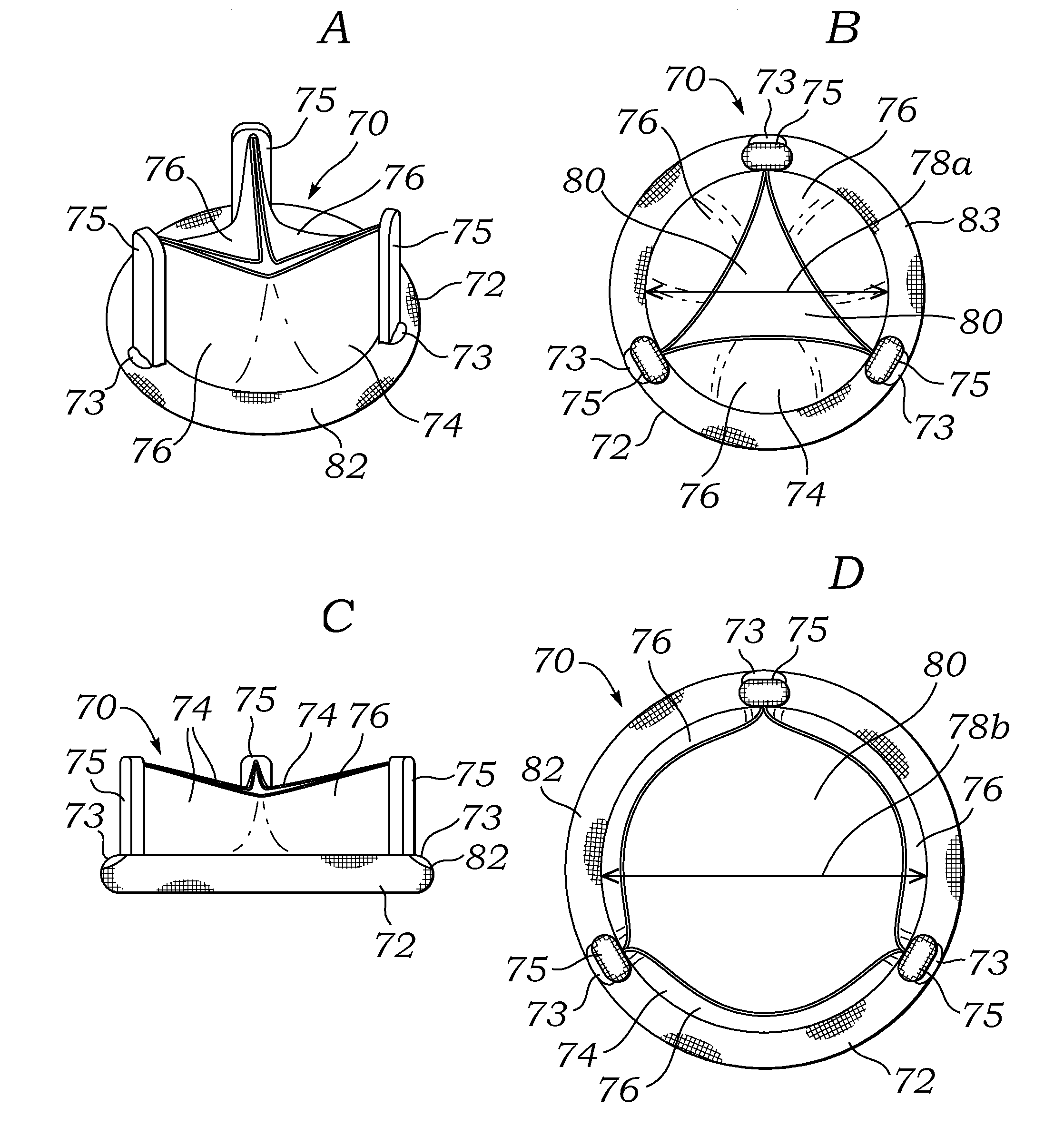 Post-implant expandable surgical heart valve configurations