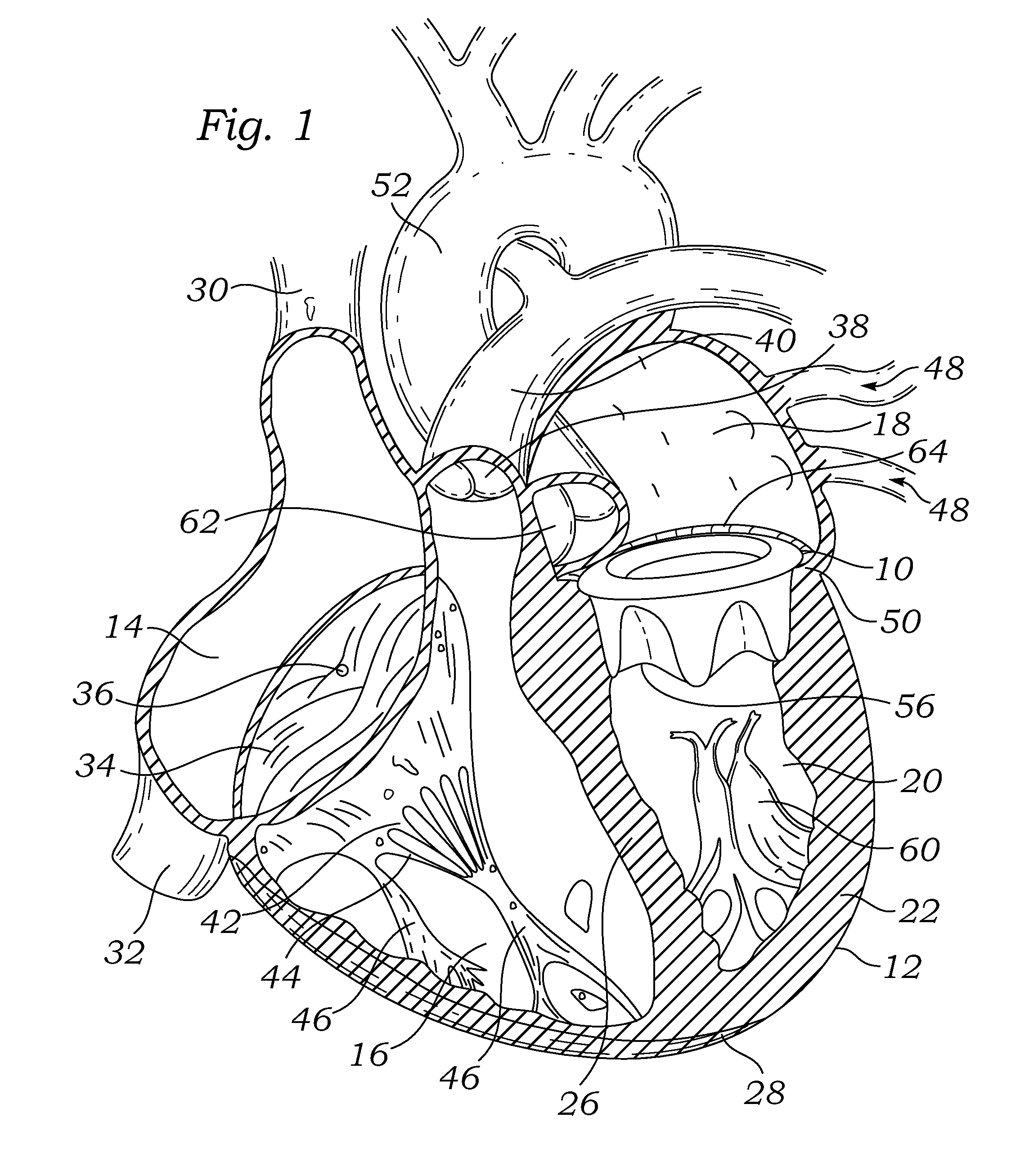 Post-implant expandable surgical heart valve configurations