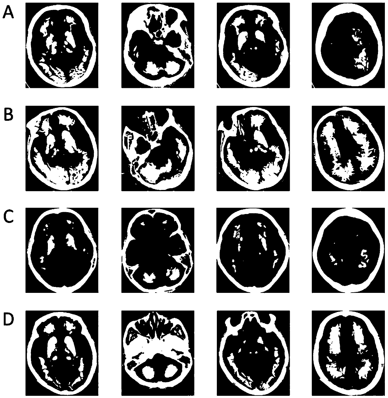 Primary familial brain calcification pathogenic gene JAM2 and application thereof