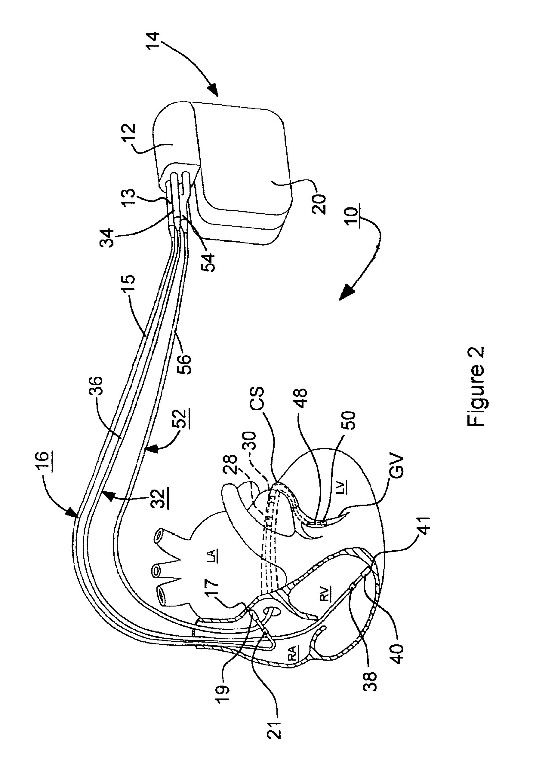 System and method for bi-ventricular fusion pacing