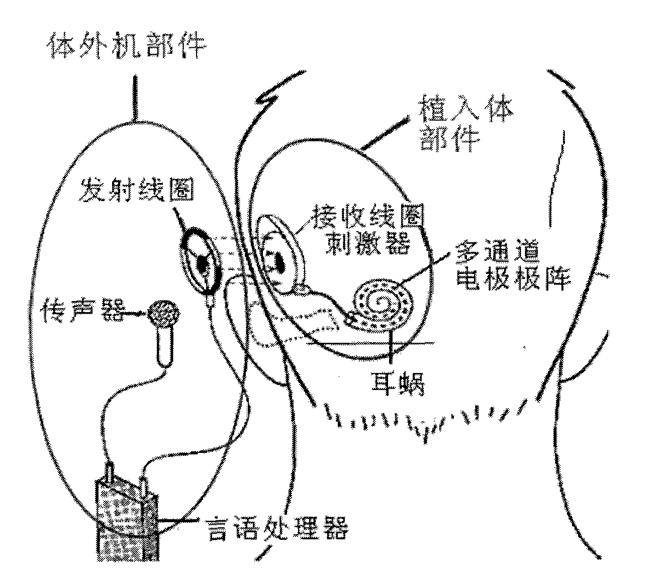 Artificial electronic cochlea and method for processing speech with double stimulation rates