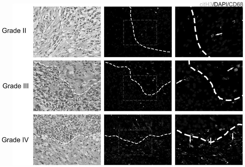 Application of METs as molecular marker in evaluation of clinical prognosis of glioma patient