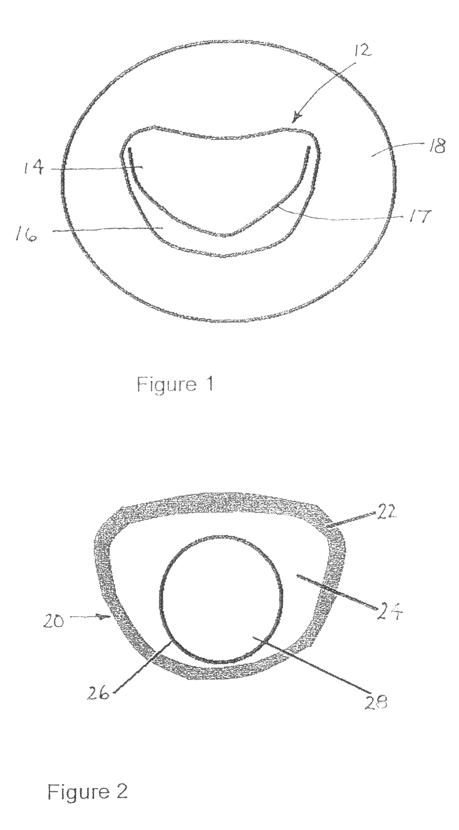 Implantable scaffolding containing an orifice for use with a prosthetic or bio-prosthetic valve