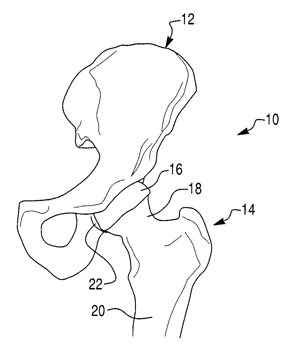 Prosthetic device and system for preparing a bone to receive a prosthetic device