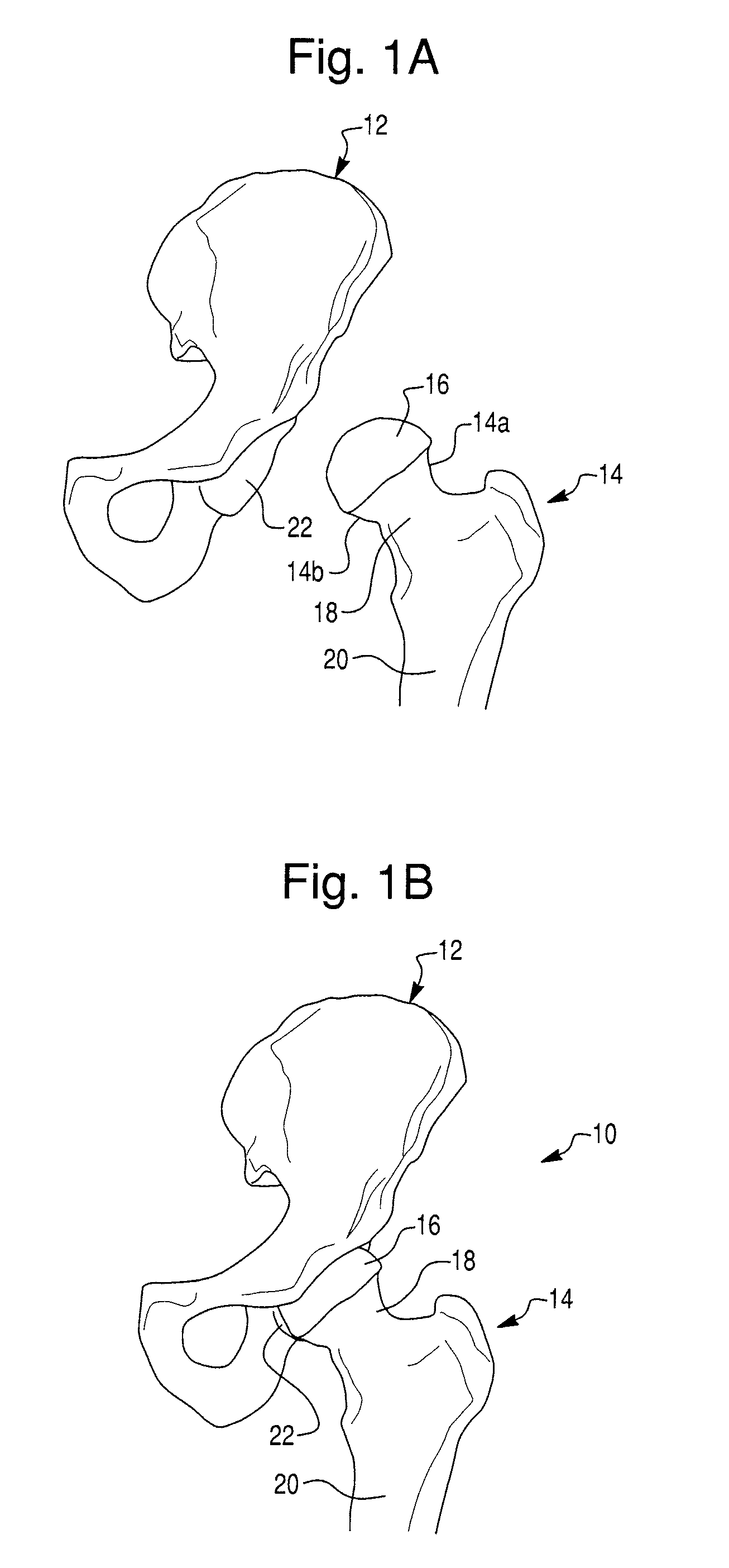 Prosthetic device and system for preparing a bone to receive a prosthetic device