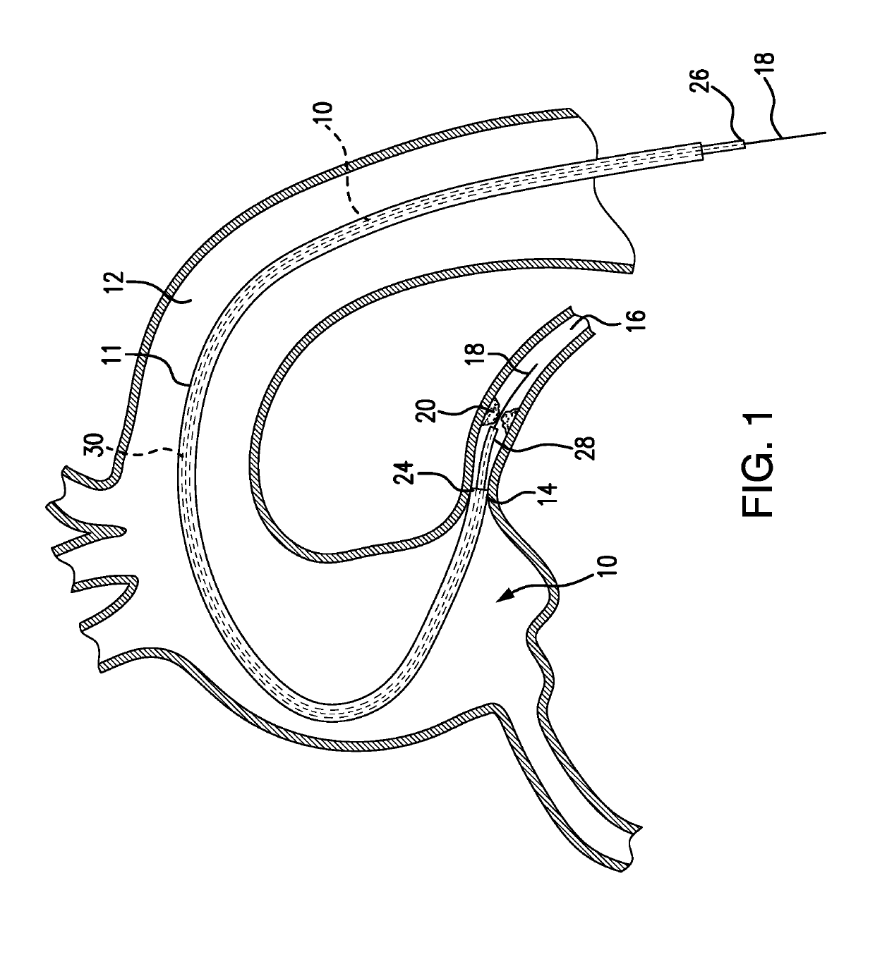 Guide catheter extension system with a delivery micro-catheter configured to facilitate percutaneous coronary intervention