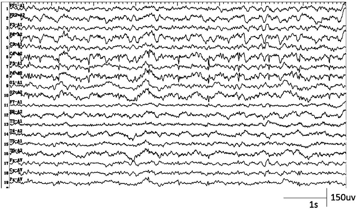 Method for automatically detecting interictal spike waves of epilepsy