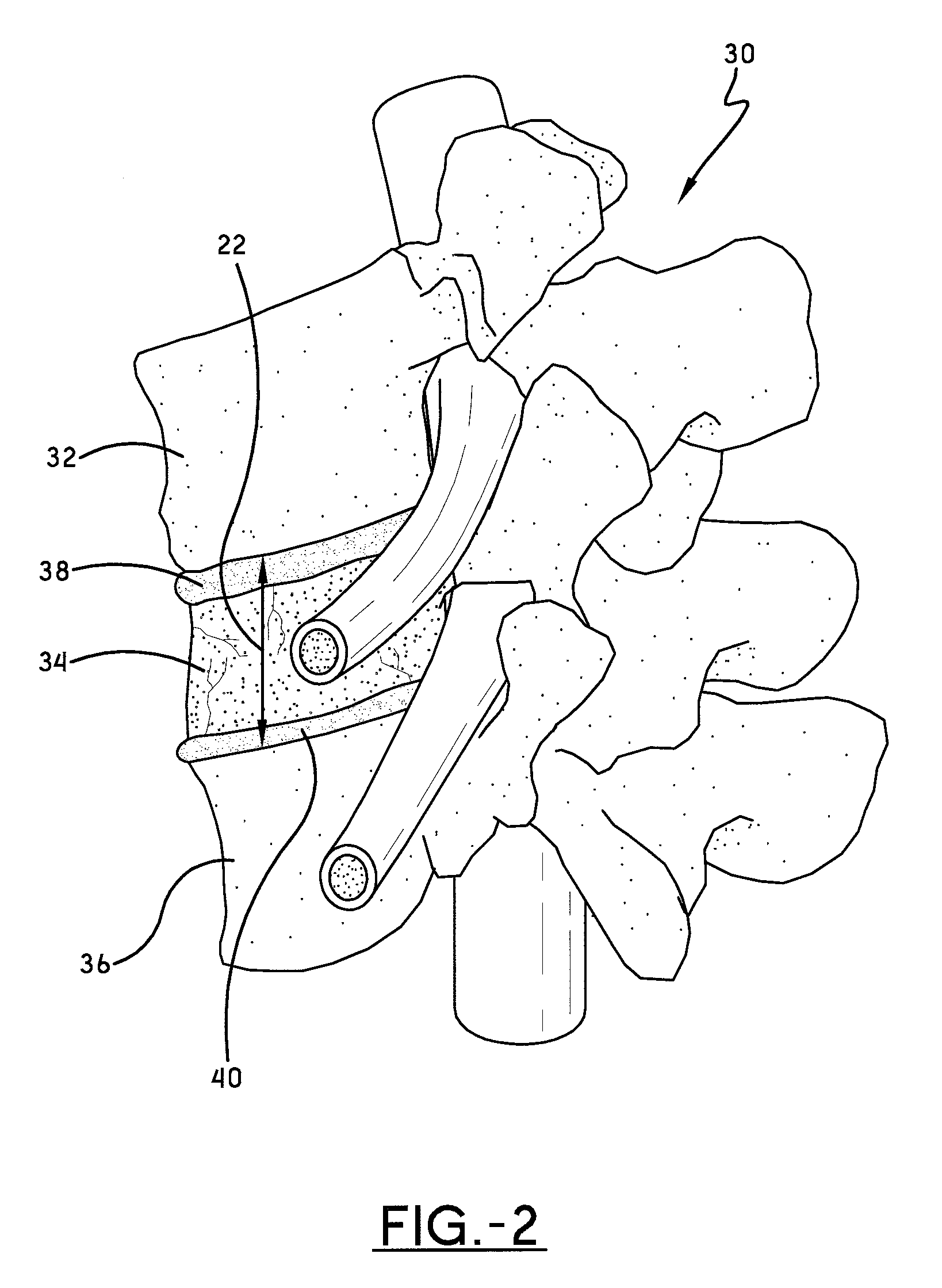 Spine surgery method and extractor