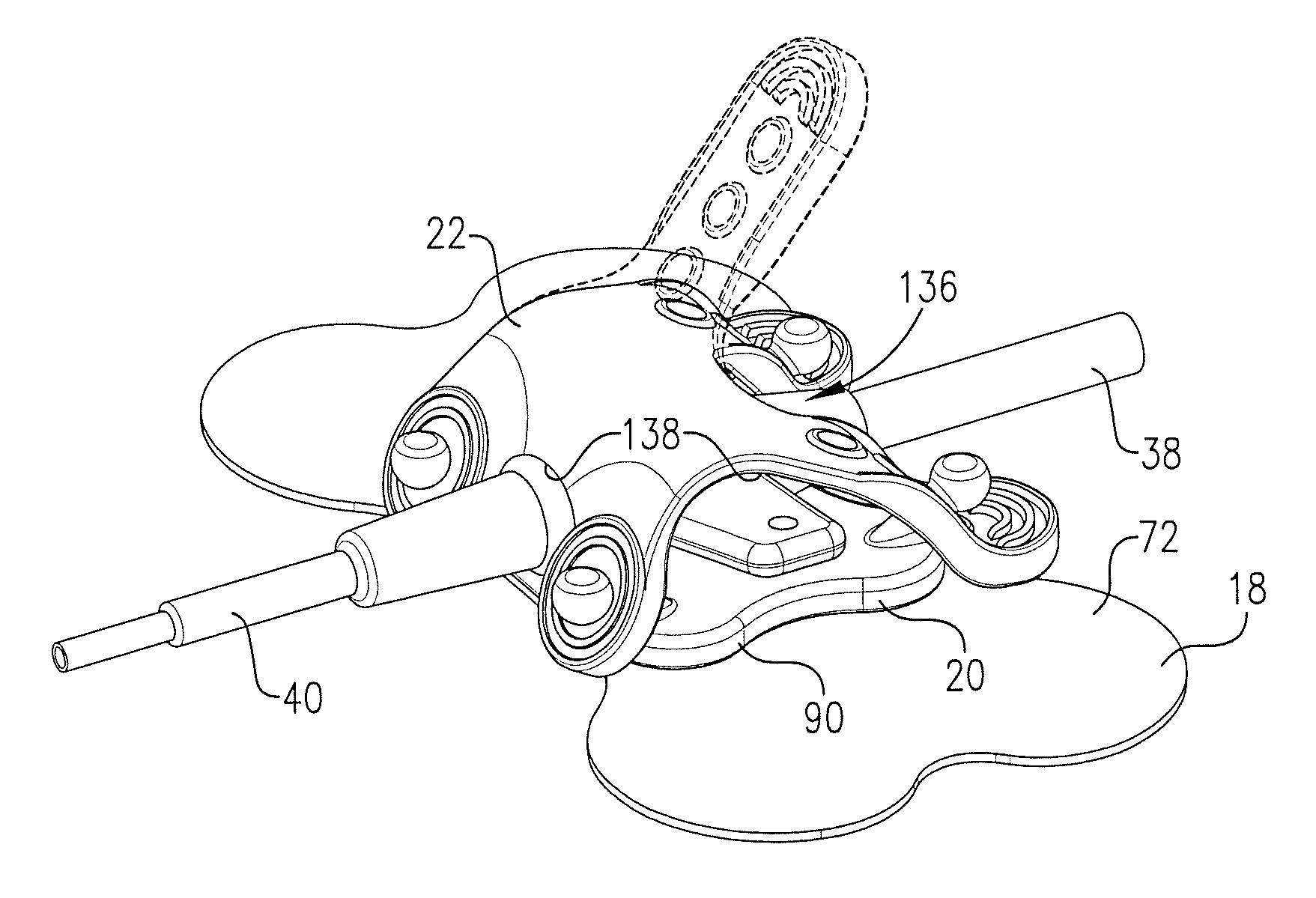 Intravenous catheter anchoring device