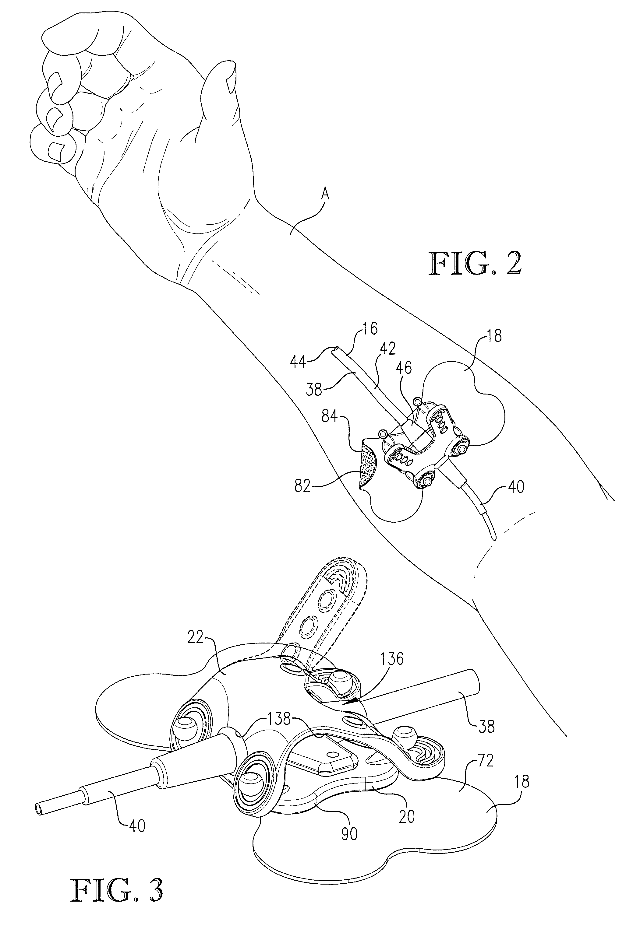 Intravenous catheter anchoring device