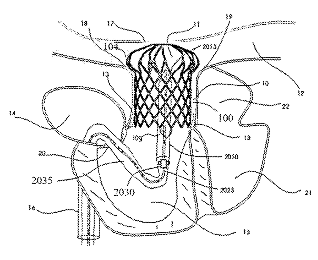 Transcatheter pulmonary ball valve assembly