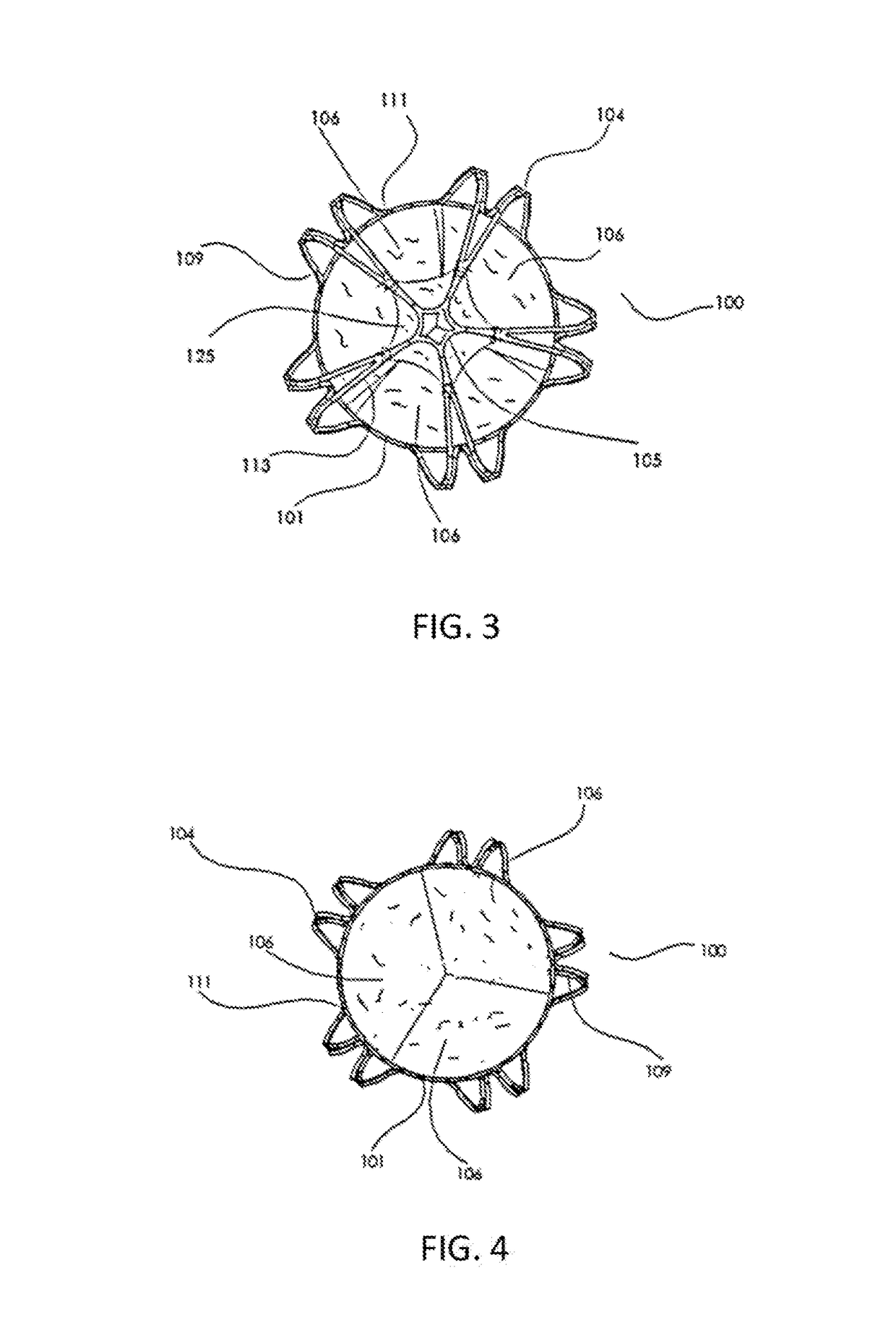 Transcatheter pulmonary ball valve assembly