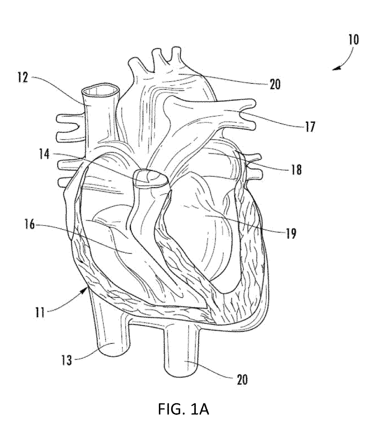 Systems and methods for selectively occluding the superior vena cava for treating heart conditions