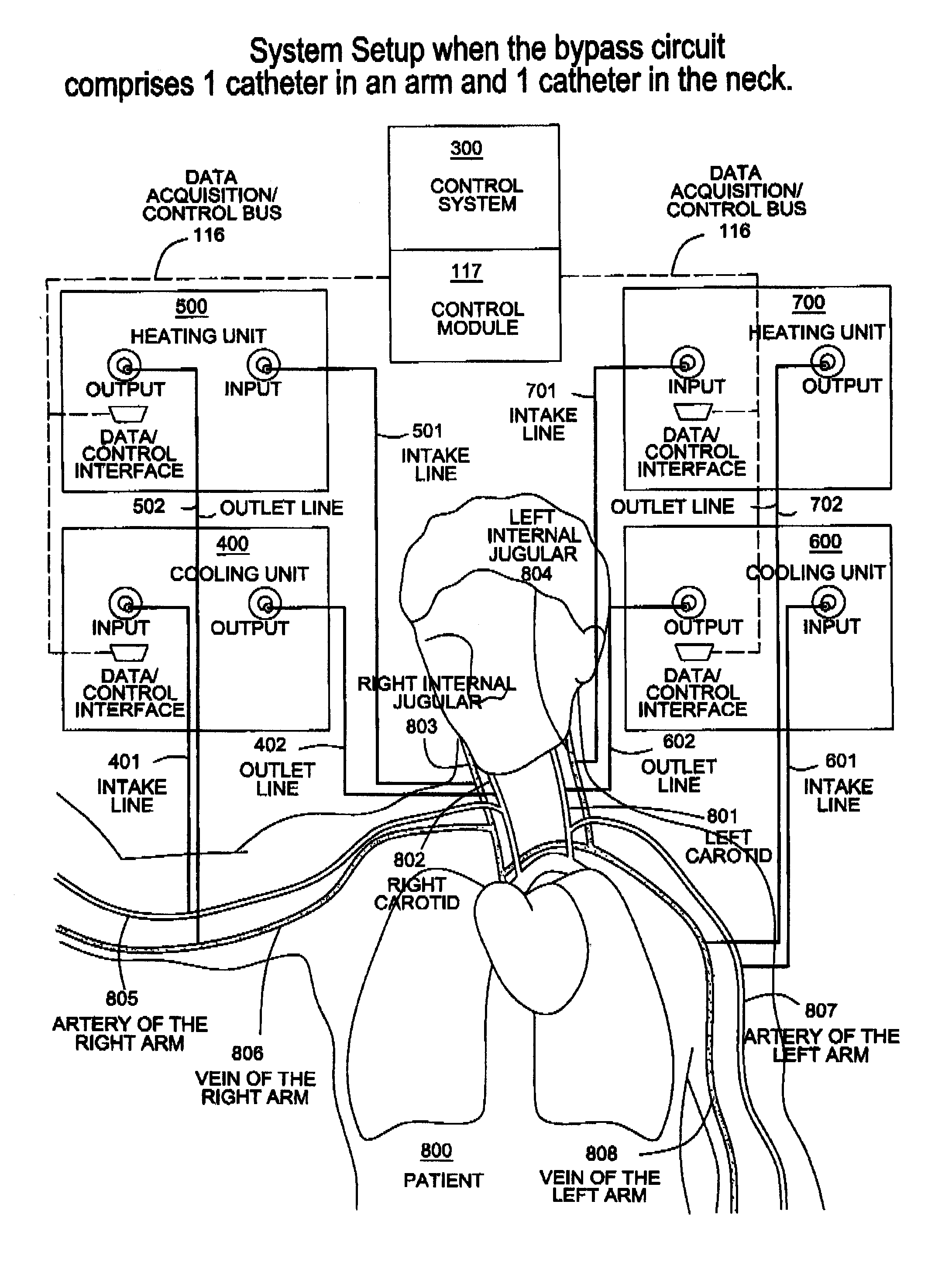 Apparatus, system and methods for extracorporeal blood processing for selectively cooling the brain relative to the body during hyperthermic treatment or to induce hypothermia of the brain