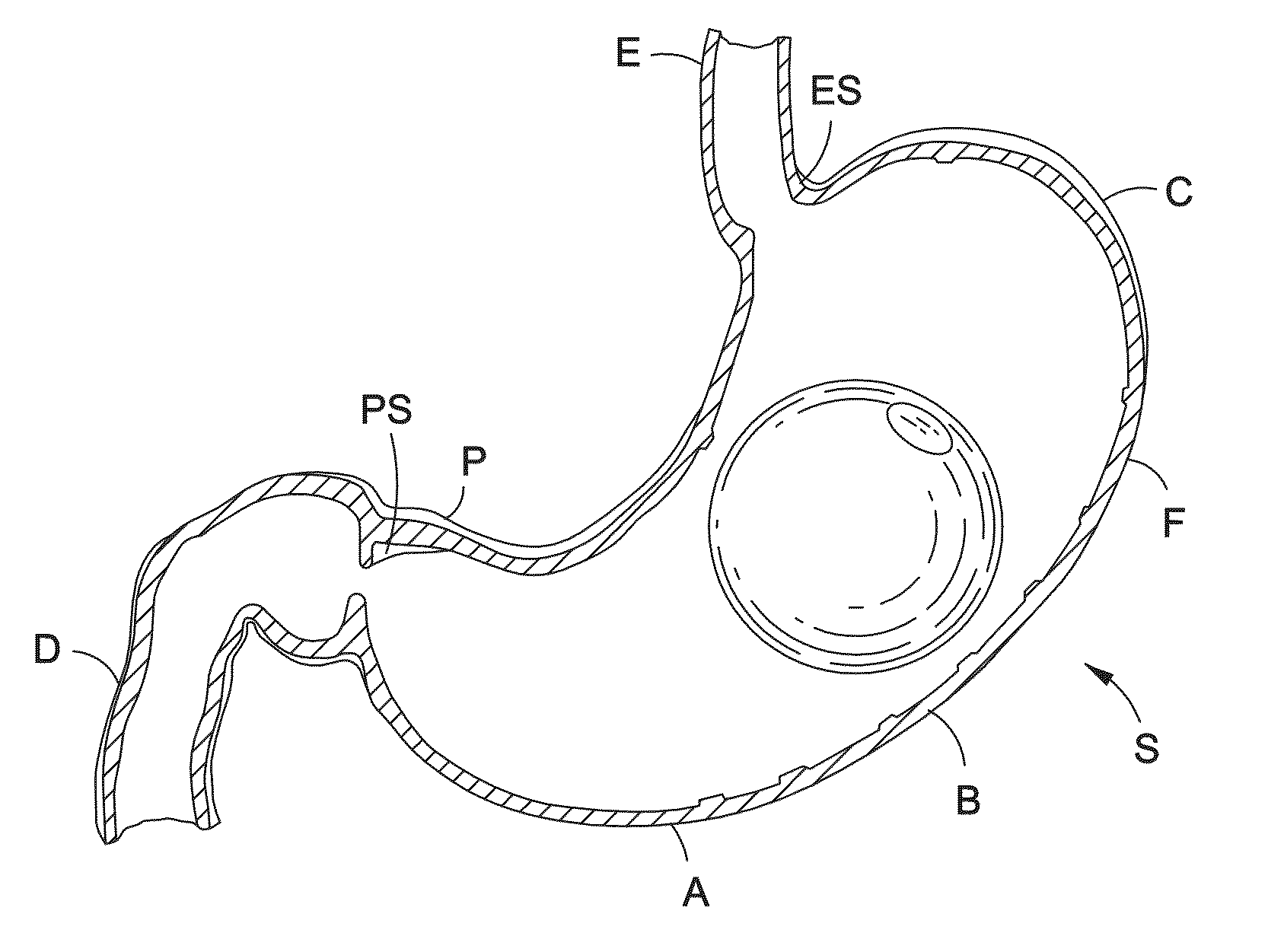 Intragastric balloon shell materials and construction