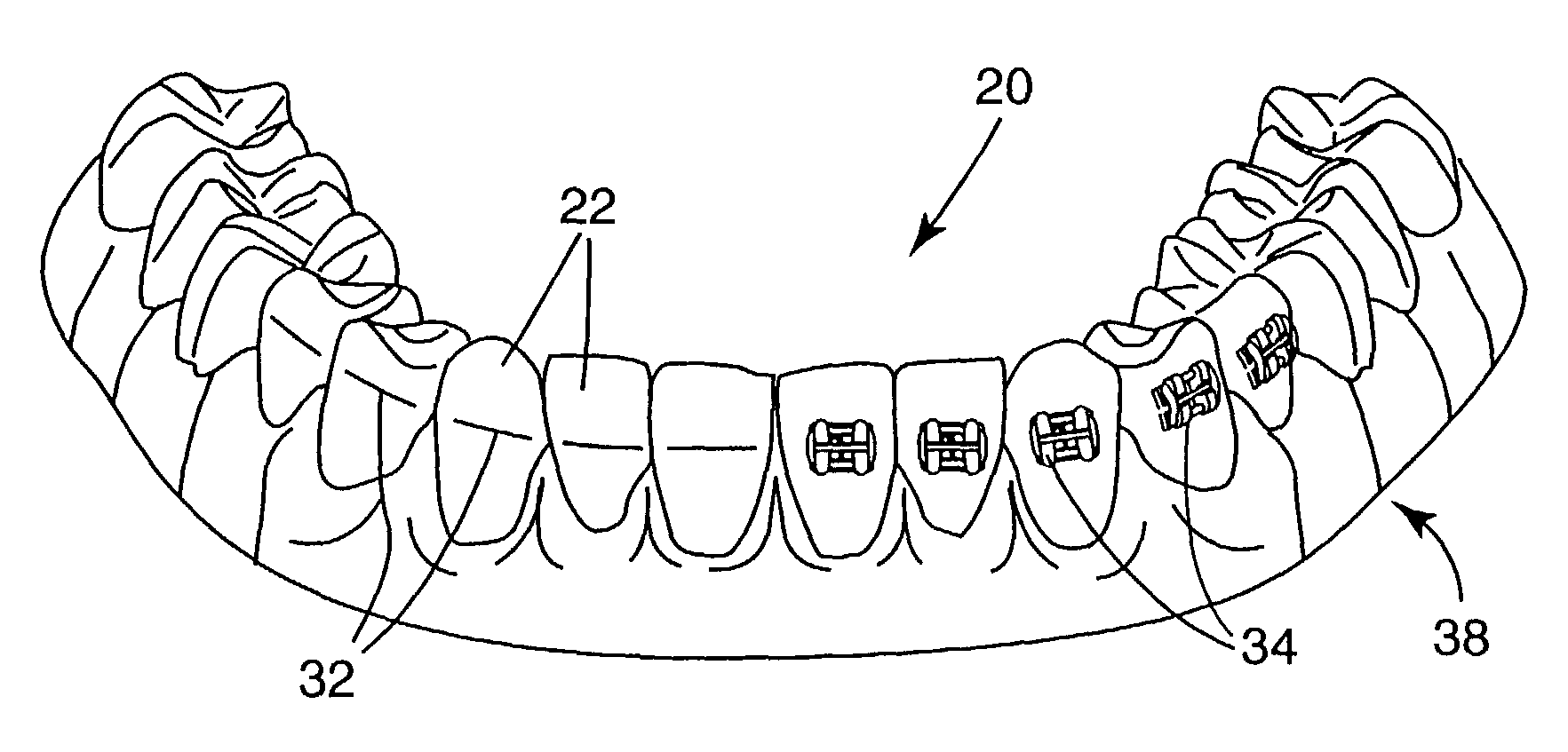 Orthodontic appliances having a contoured bonding surface