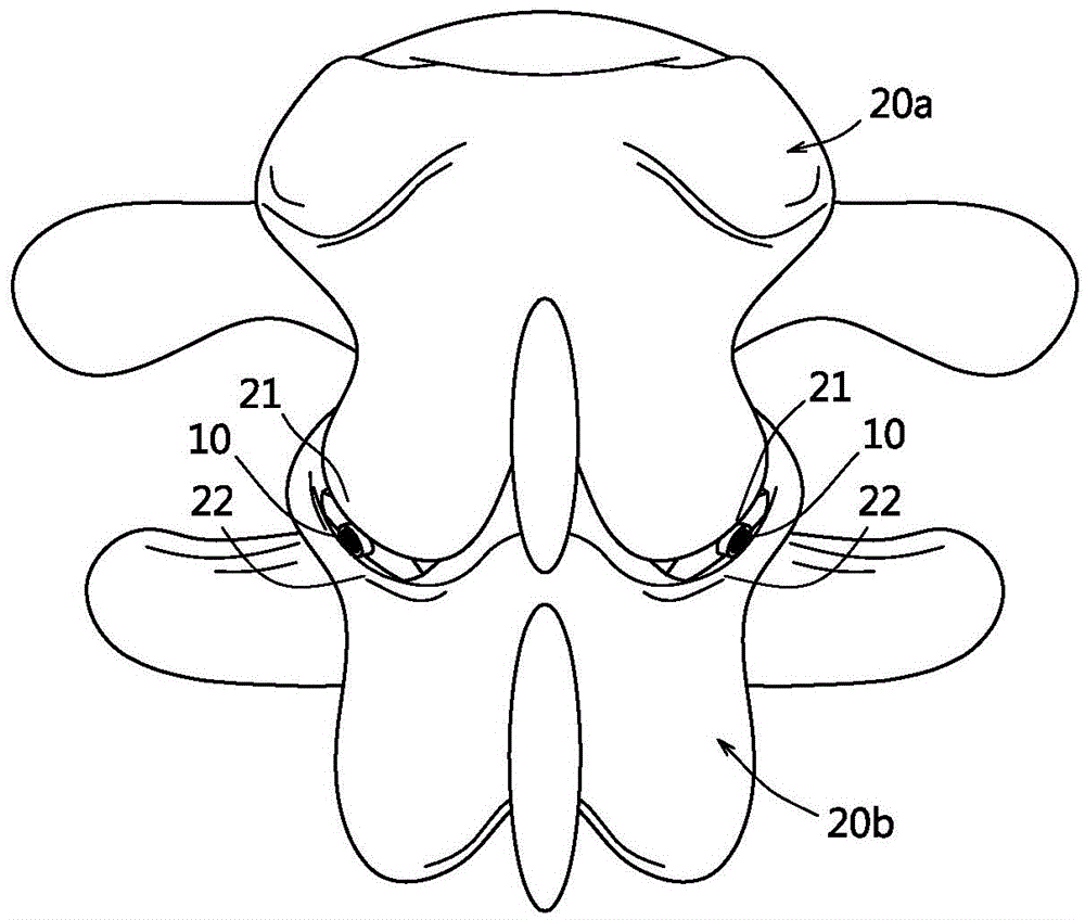 Fixer with stereo grids for vertebra facet joint fusion