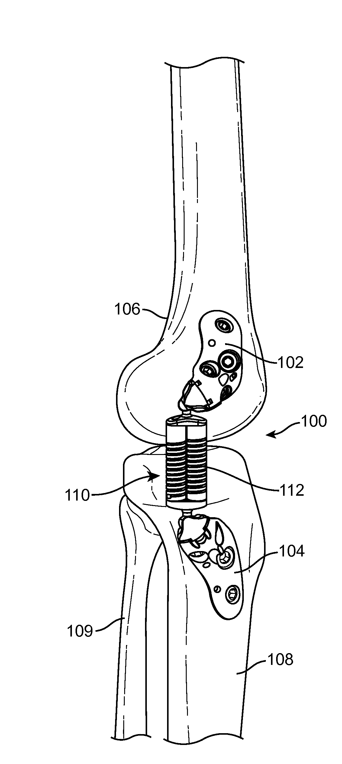Methods and Devices for Joint Load Control During Healing of Joint Tissue