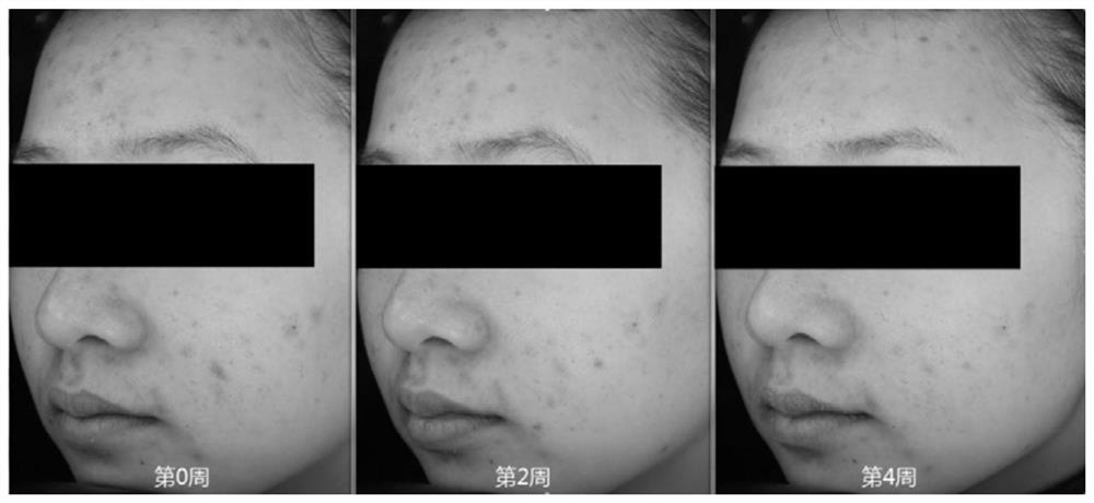 Acne mark removing composition and application thereof