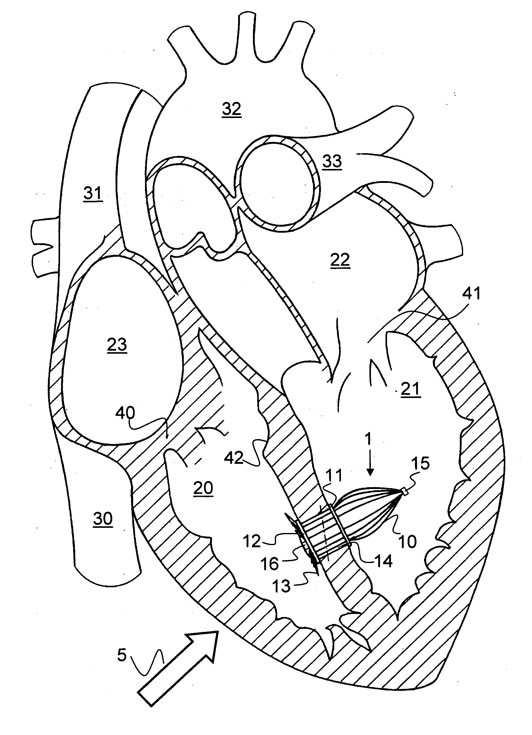 Method for delivering a medical device to the heart of a patient