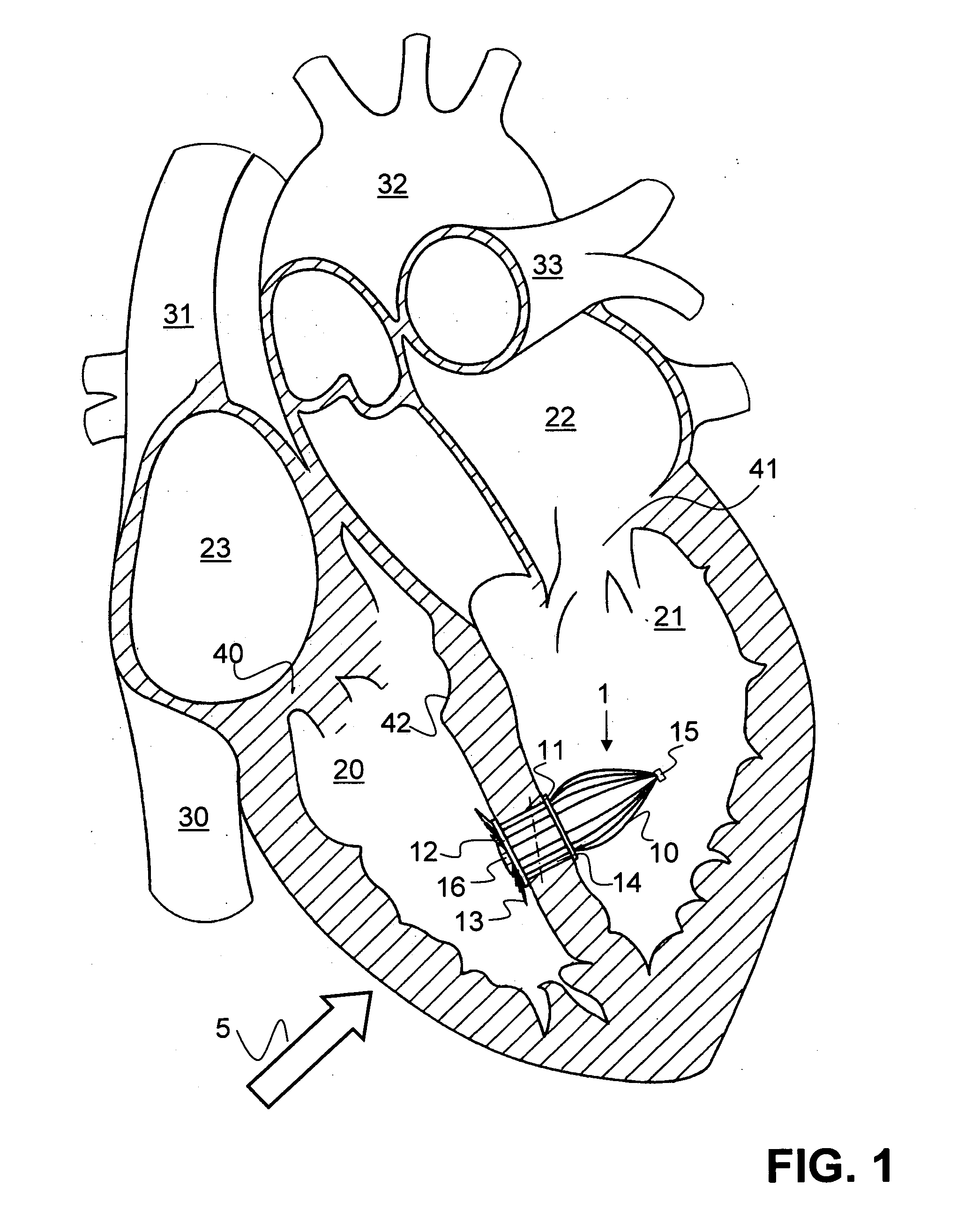 Method for delivering a medical device to the heart of a patient