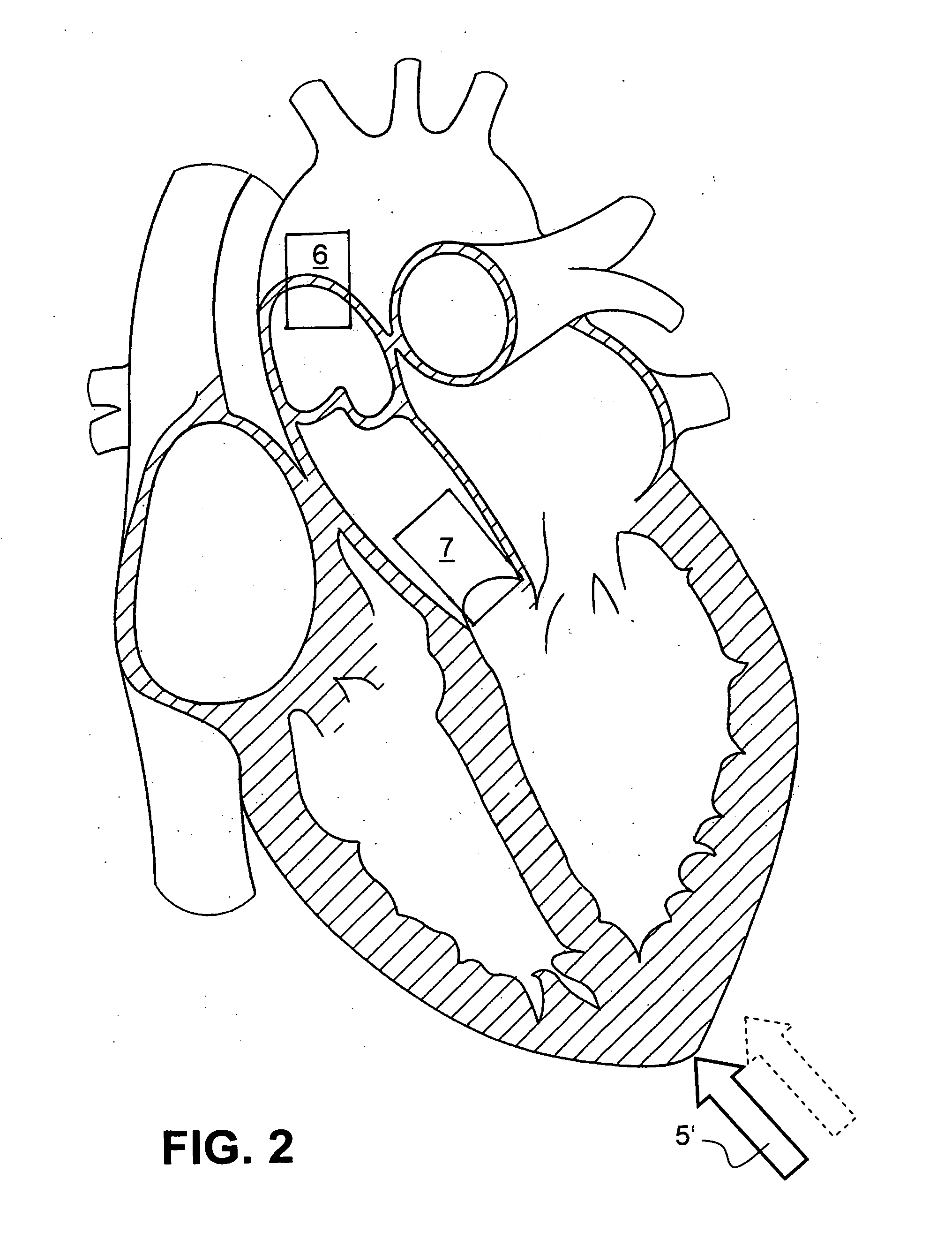 Method for delivering a medical device to the heart of a patient