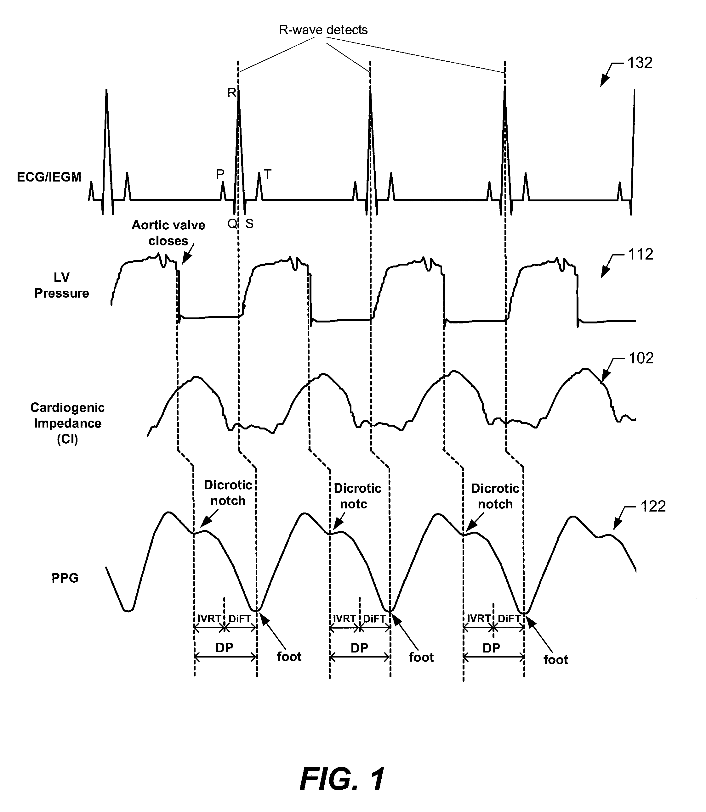 SYSTEMS AND METHODS FOR MONITORING DP, IVRT, DiFT, DIASTOLIC FUNCTION AND/OR HF