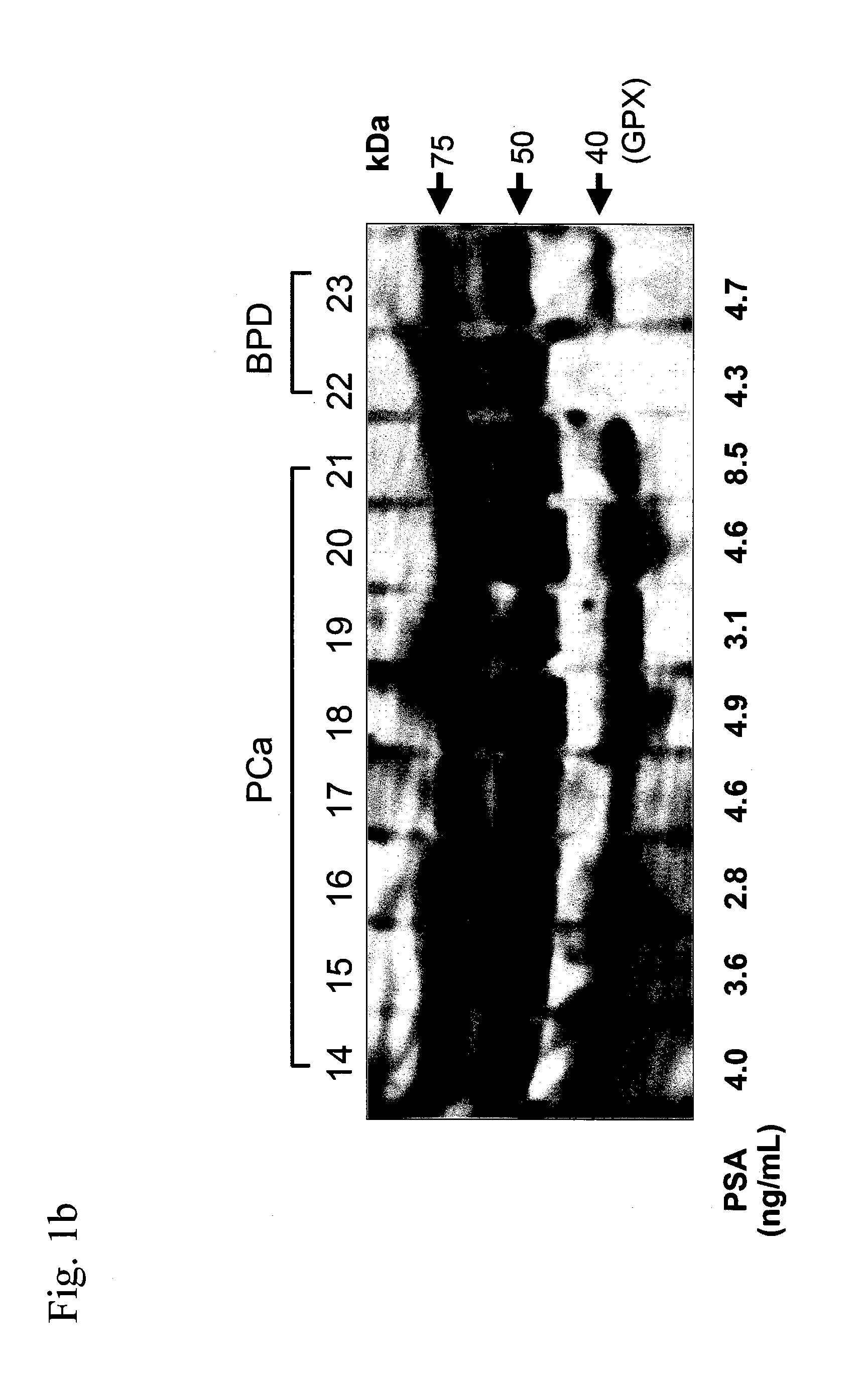 Cancer evaluation method using haptoglobin β chain defined by antibody RM2