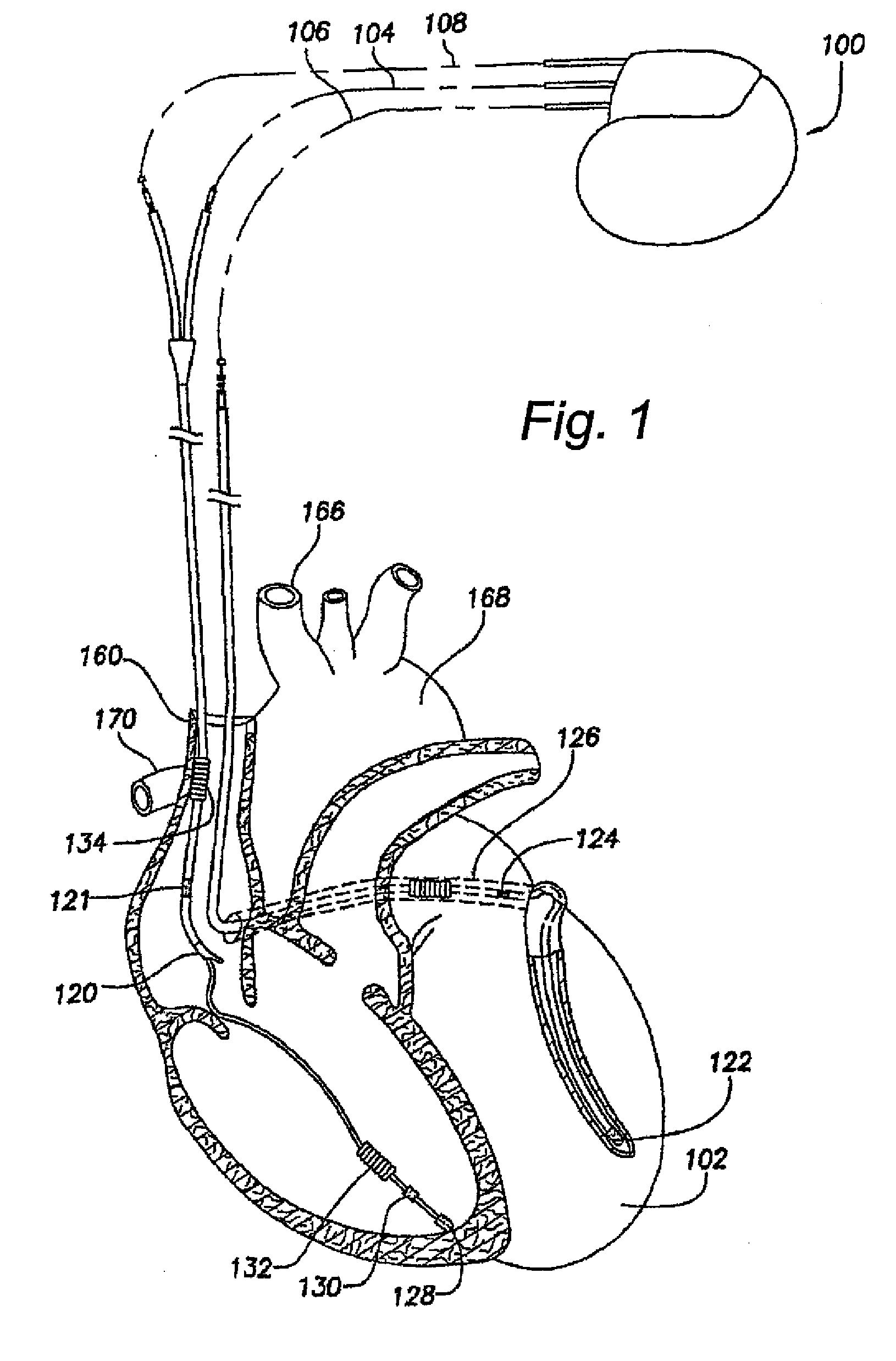 System and method for controlling a heart stimulator