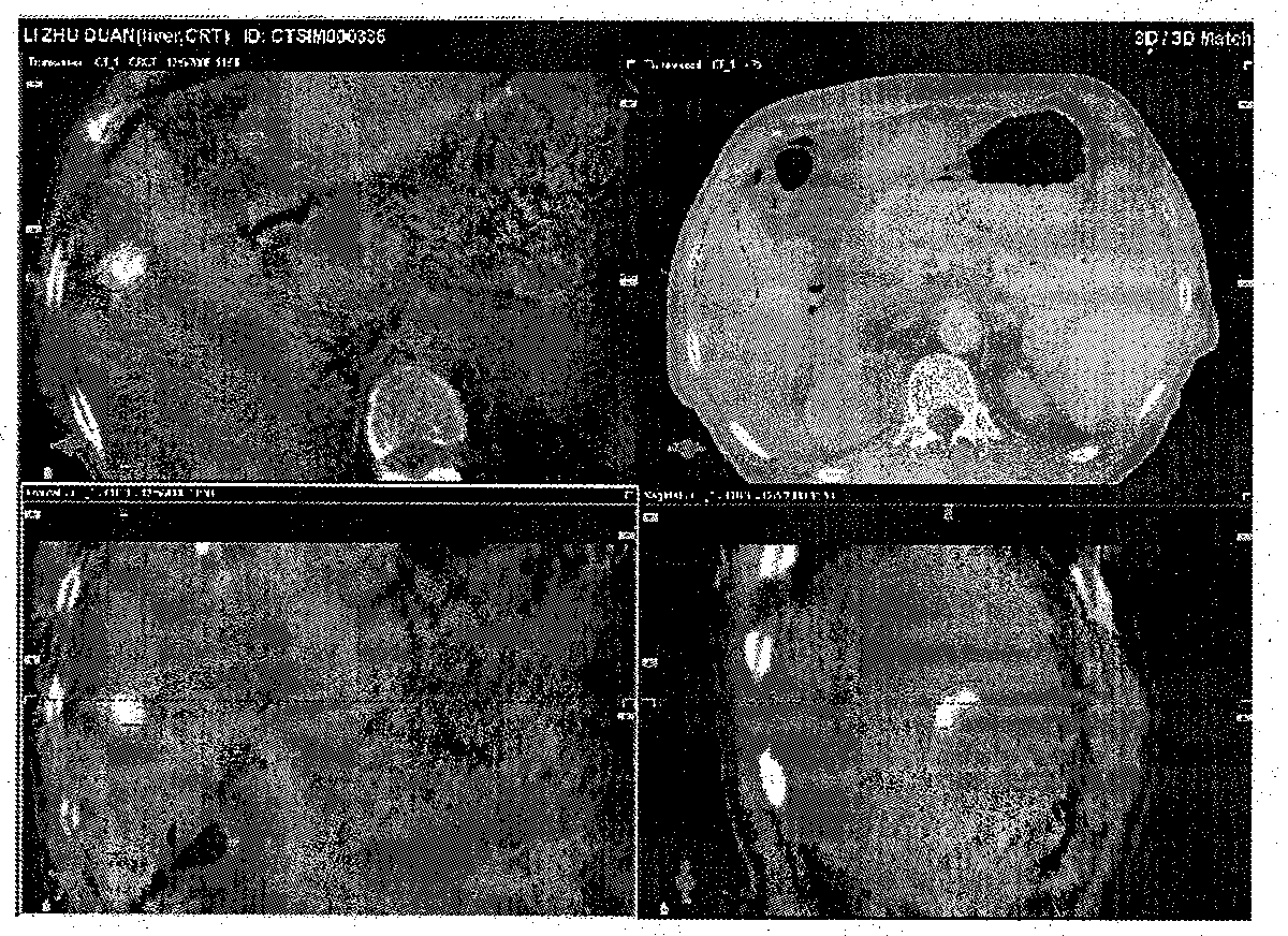 United autonomous respiration control on-line alignment technique using iodized oil image to guide image-guided radiotherapy