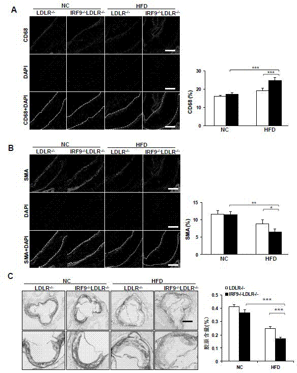 Function and application of interferon regulatory factor 9 (IRF9) gene in atherosclerosis