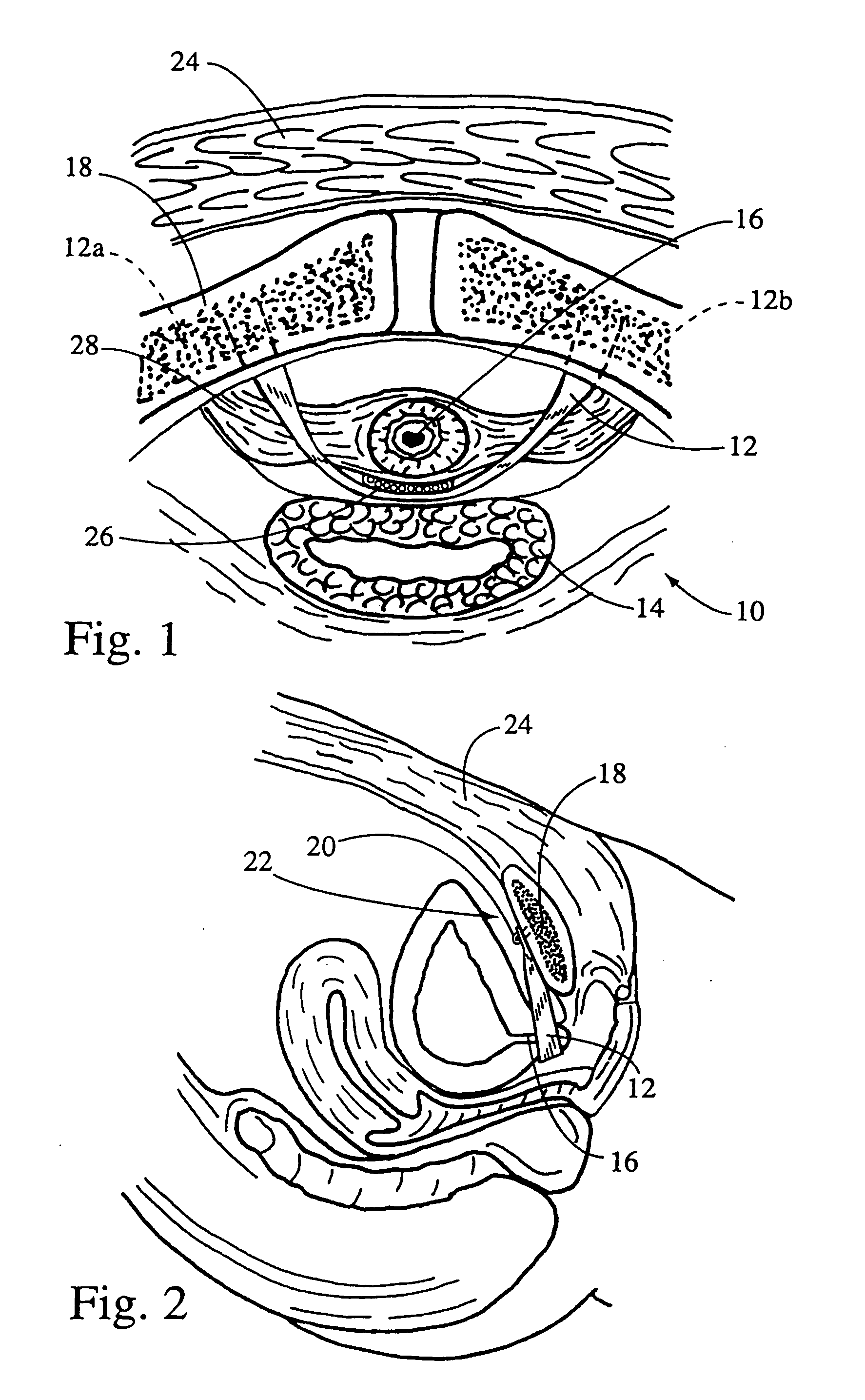System and method for securing implants to soft tissue