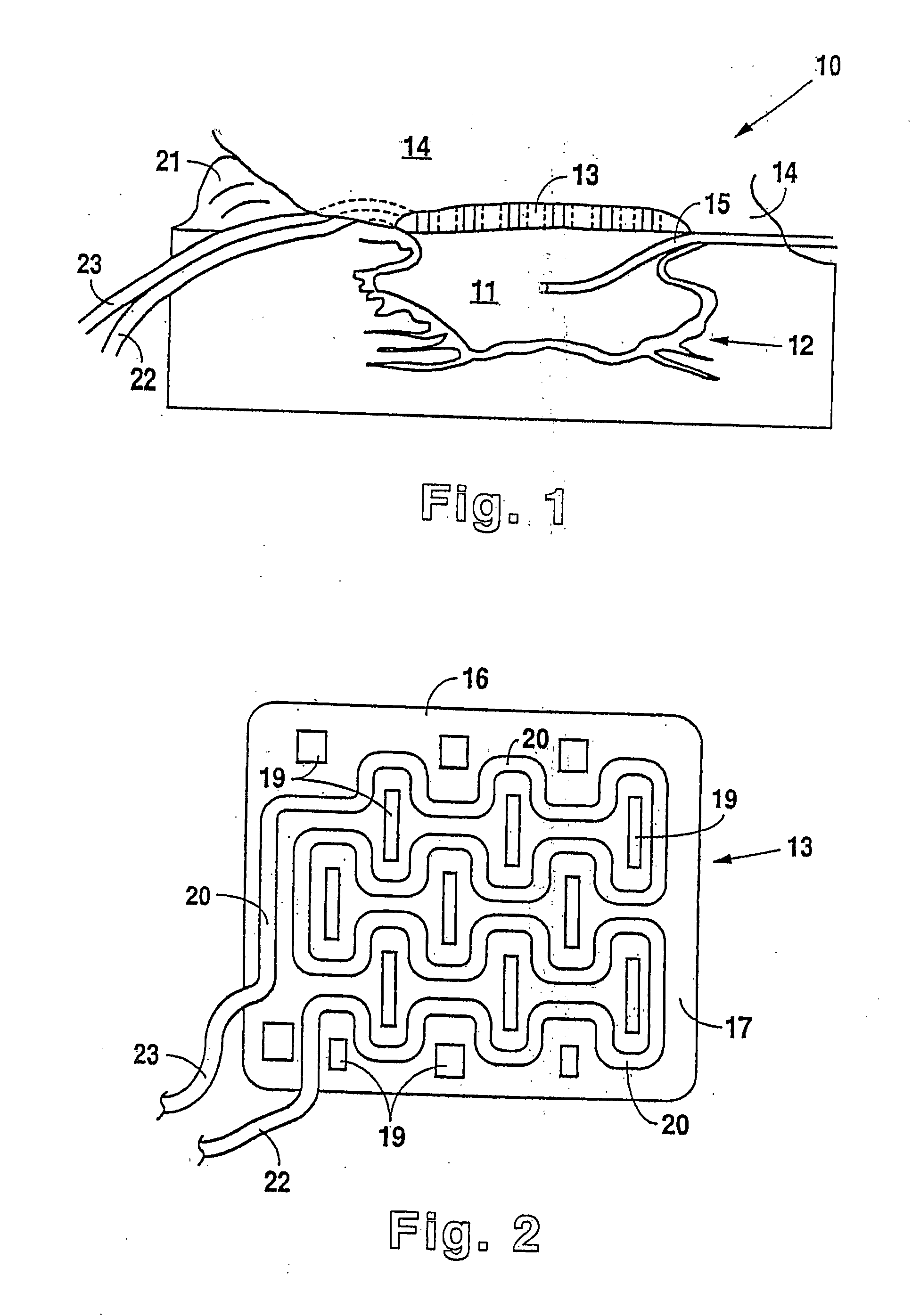 Negative pressure treatment system with heating and cooling provision