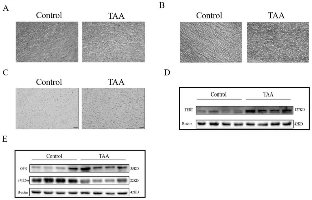 Application of reagent for inhibiting TERT expression in preparation of medicine for preventing or treating thoracic aortic aneurysm
