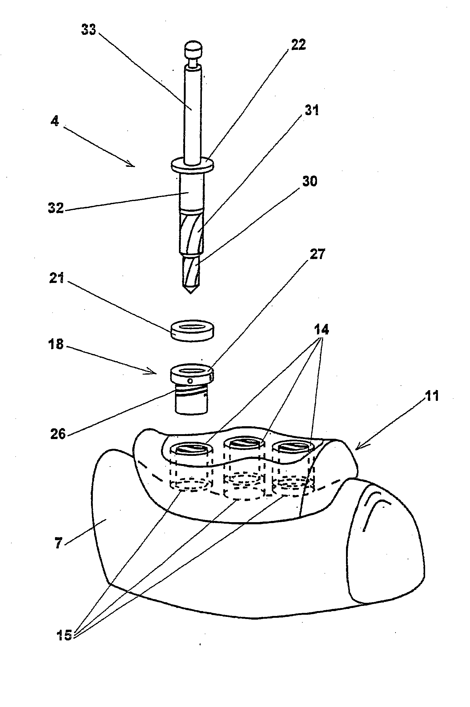 Method and device for placing dental implants