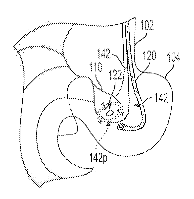 Methods for biliary diversion