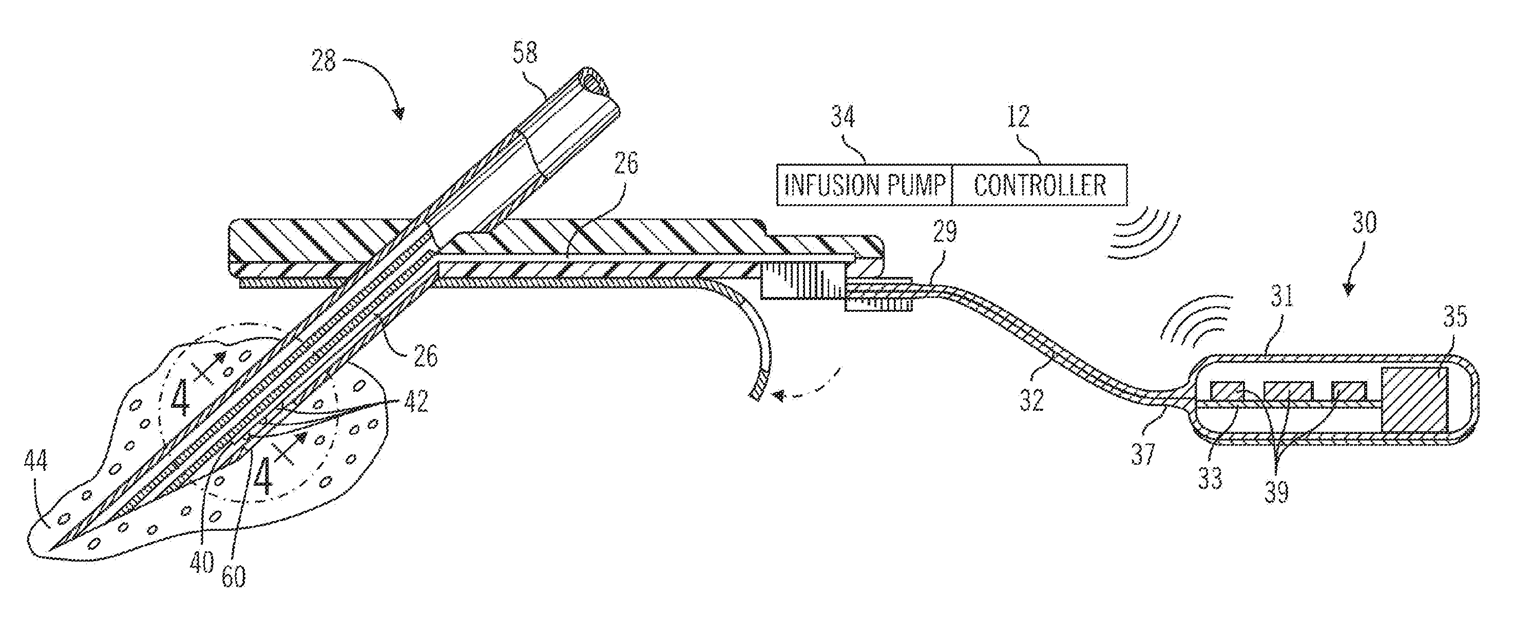 Sensor model supervisor for a closed-loop insulin infusion system