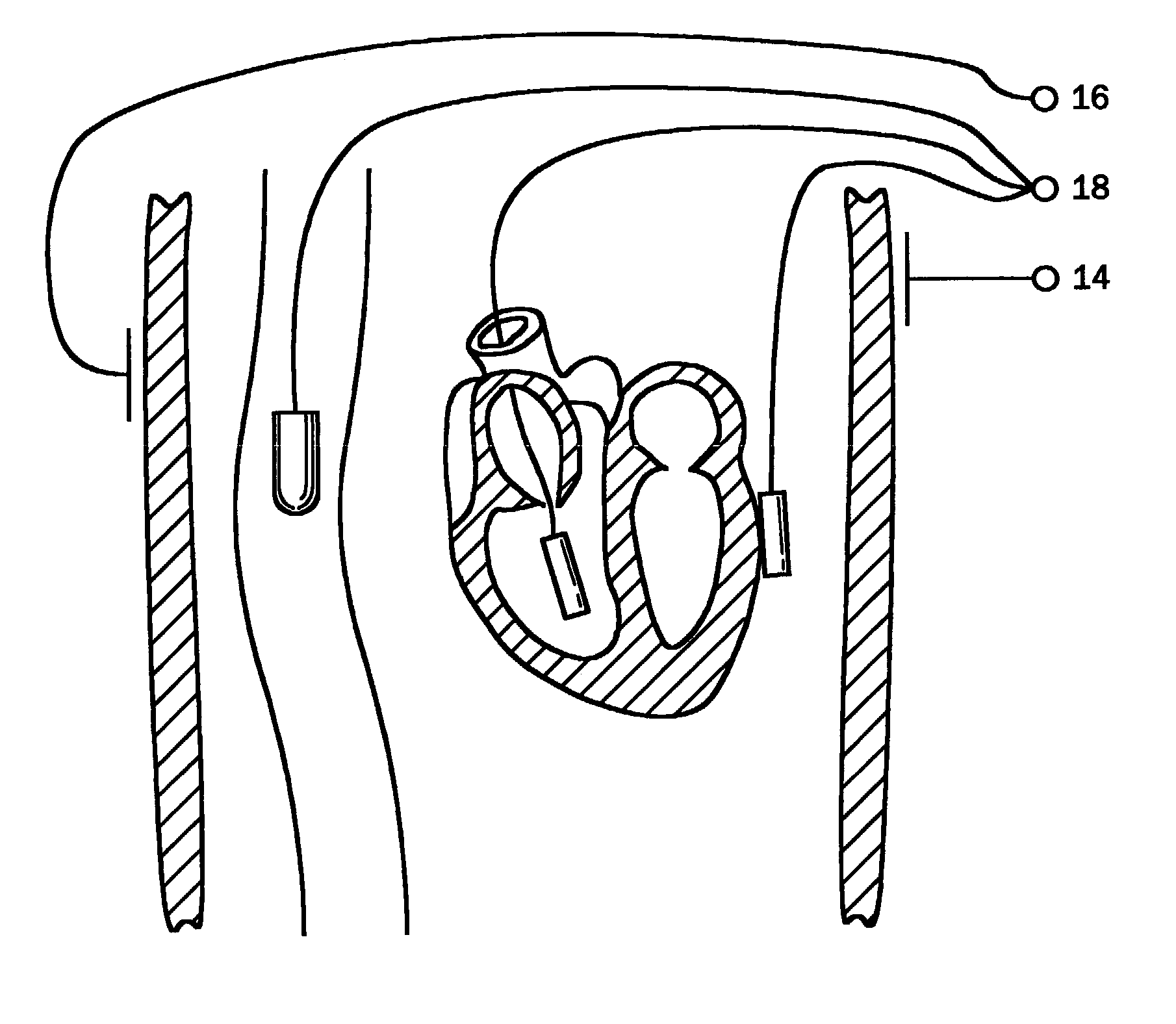 Therapeutic device and method for treating diseases of cardiac muscle