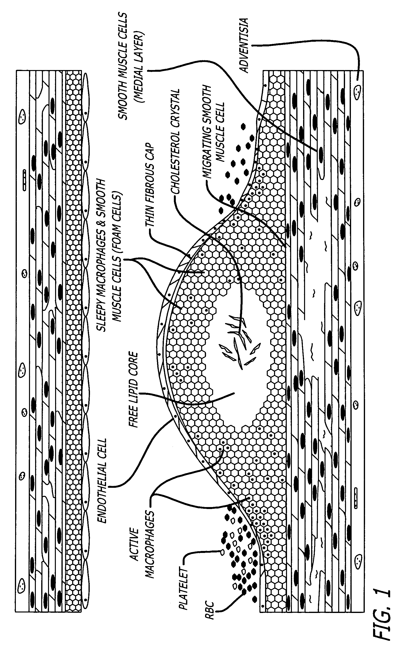 Method and apparatus for detection of vulnerable atherosclerotic plaque