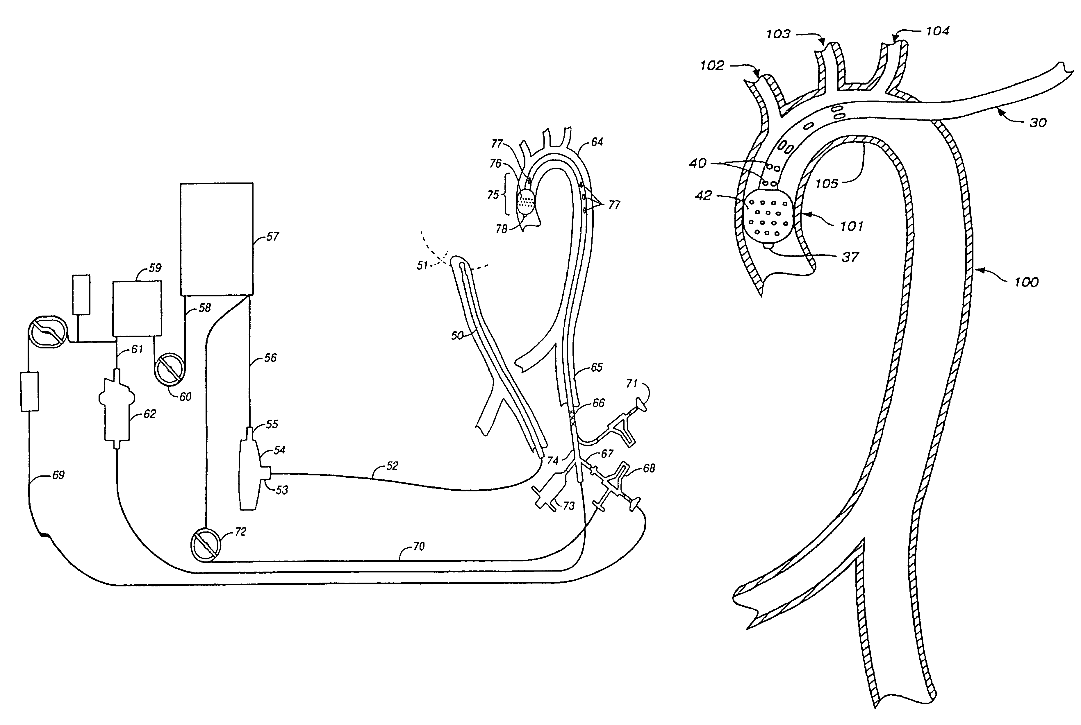 Venous cannula and cardiopulmonary bypass system