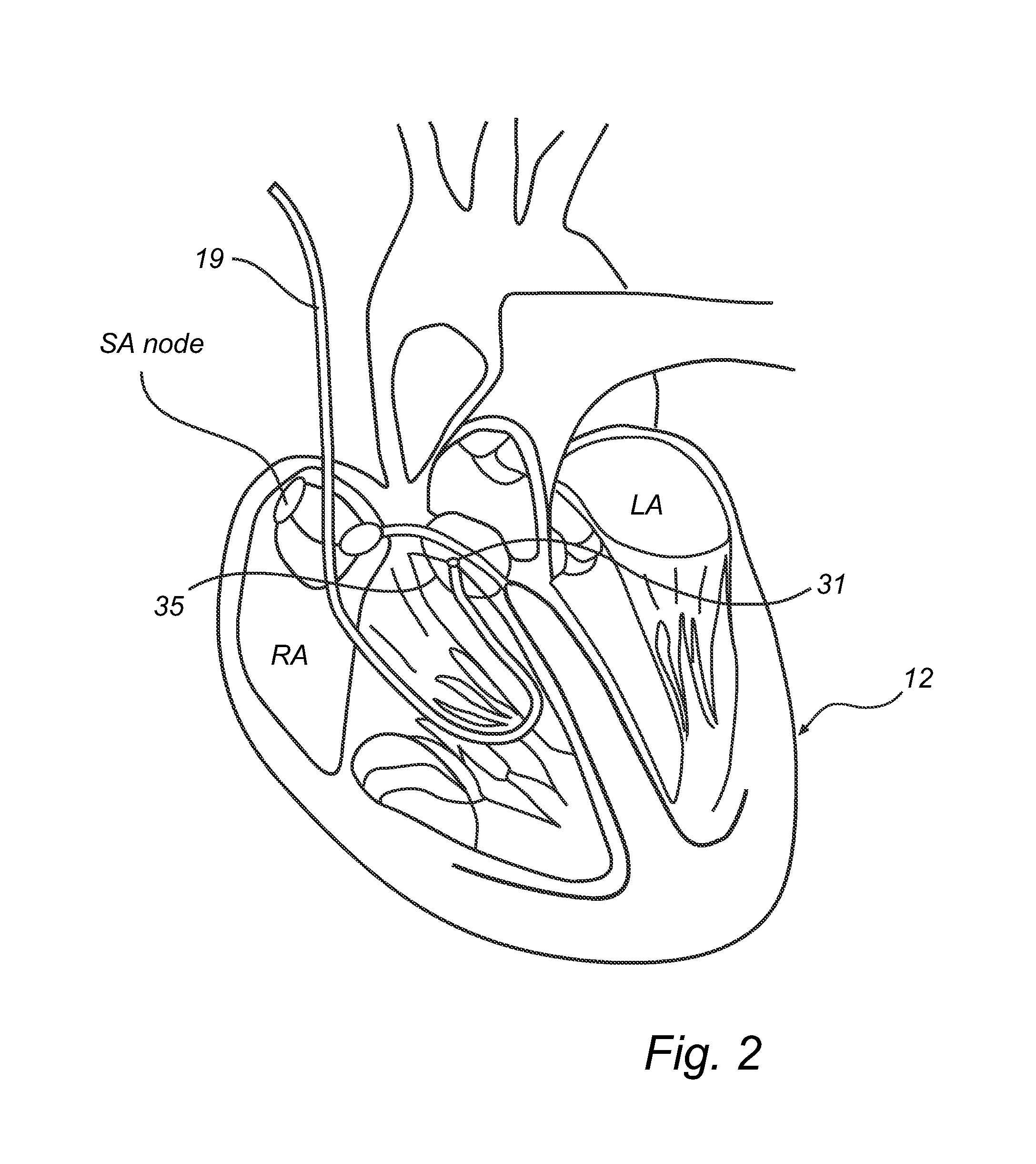 Method and system for stimulating a heart