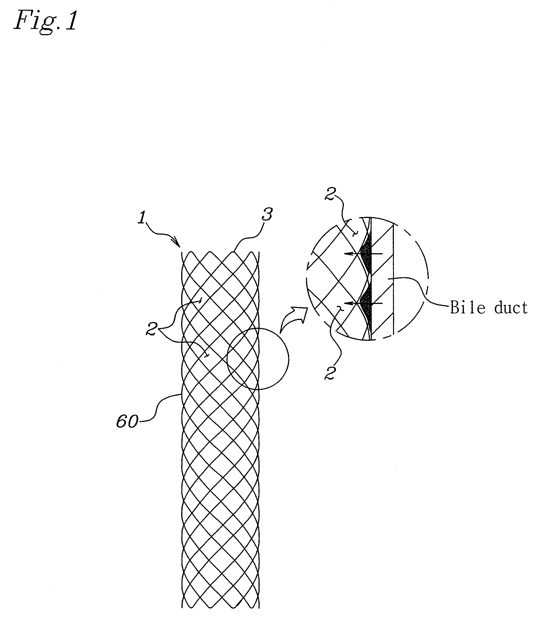 Double-tube type stent